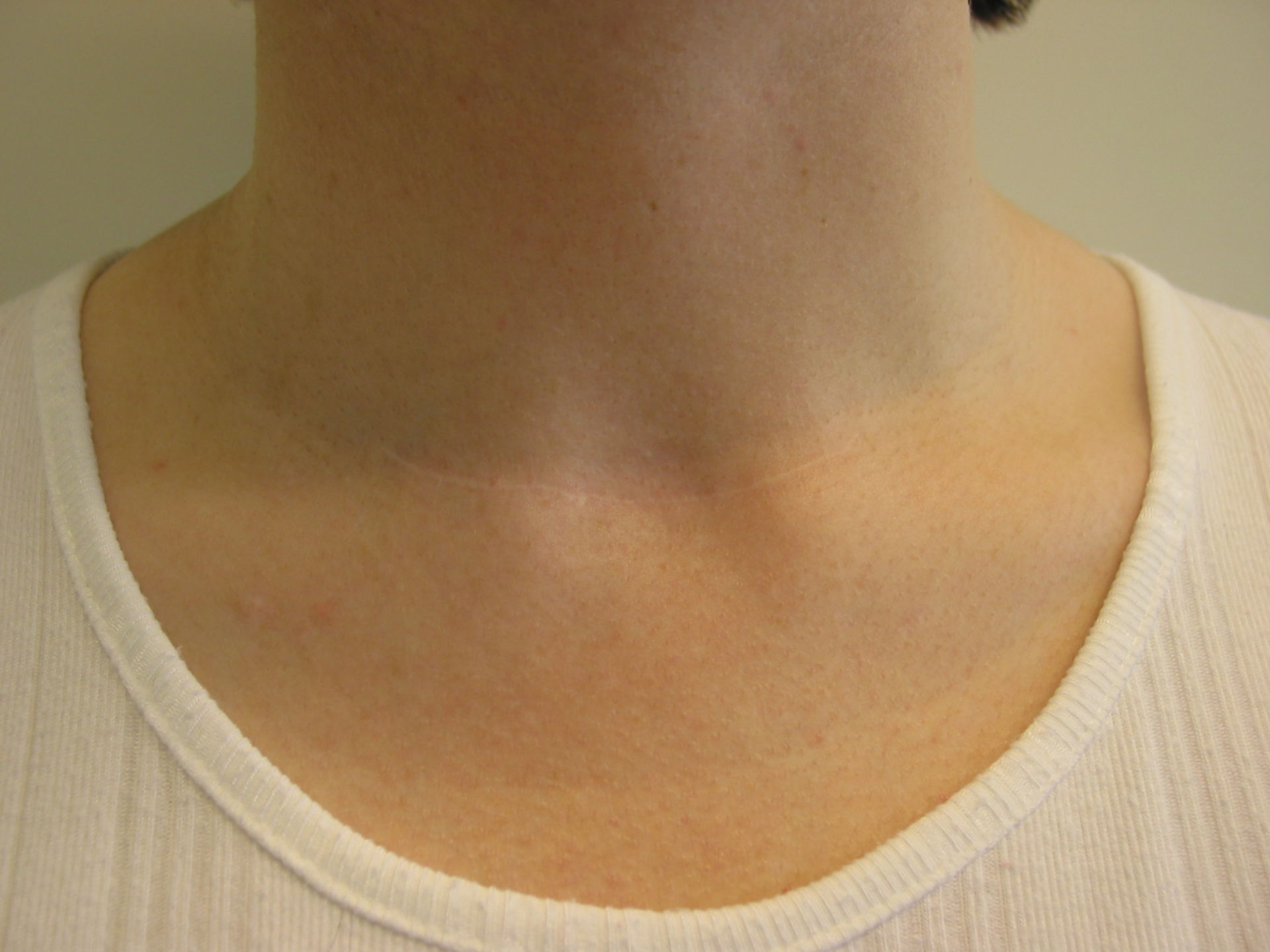 Estado posterior a una cirugía de tiroides, 6 meses después