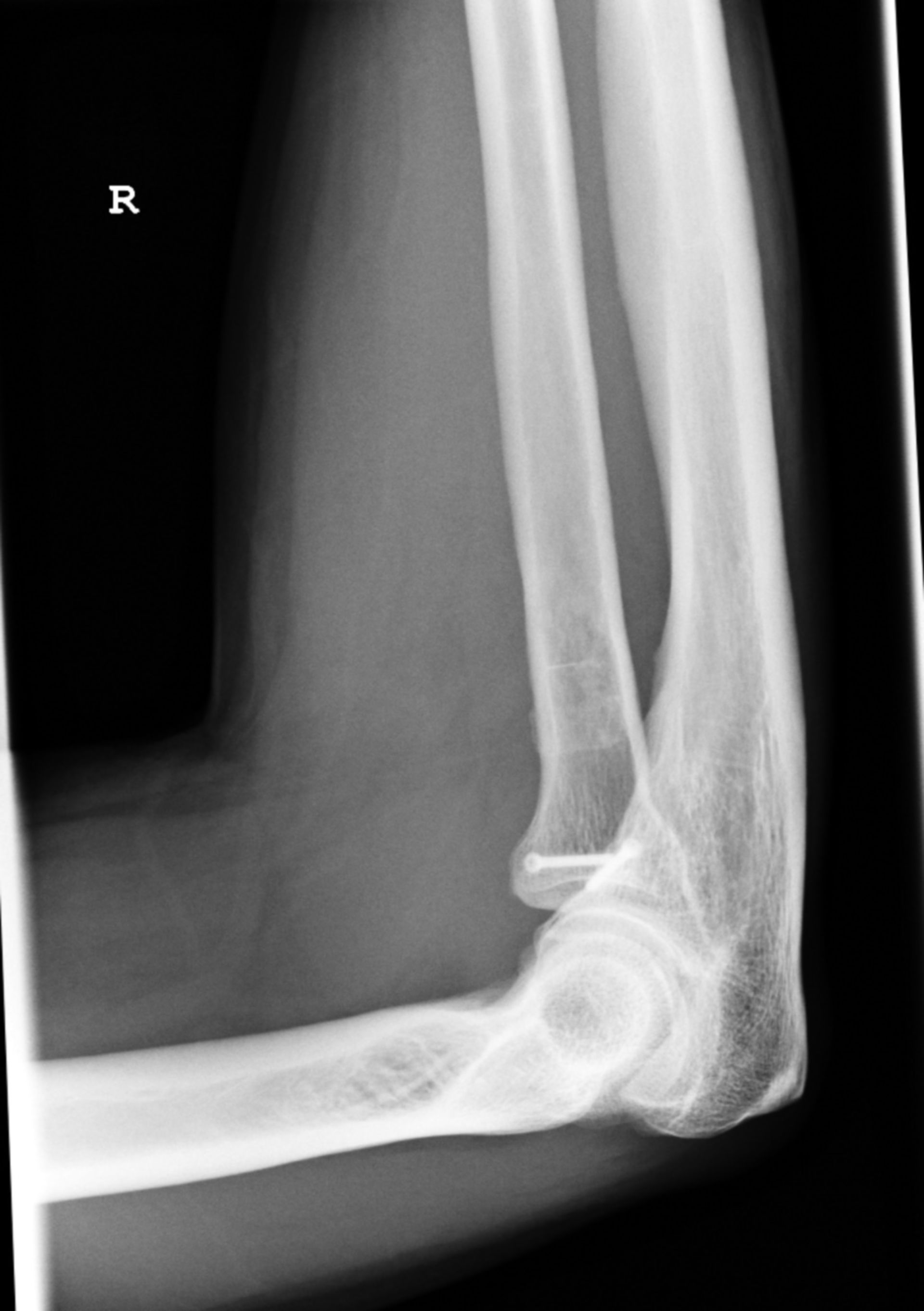 Radiusköpfchenfraktur-Schraubenosteosynthese seitlich