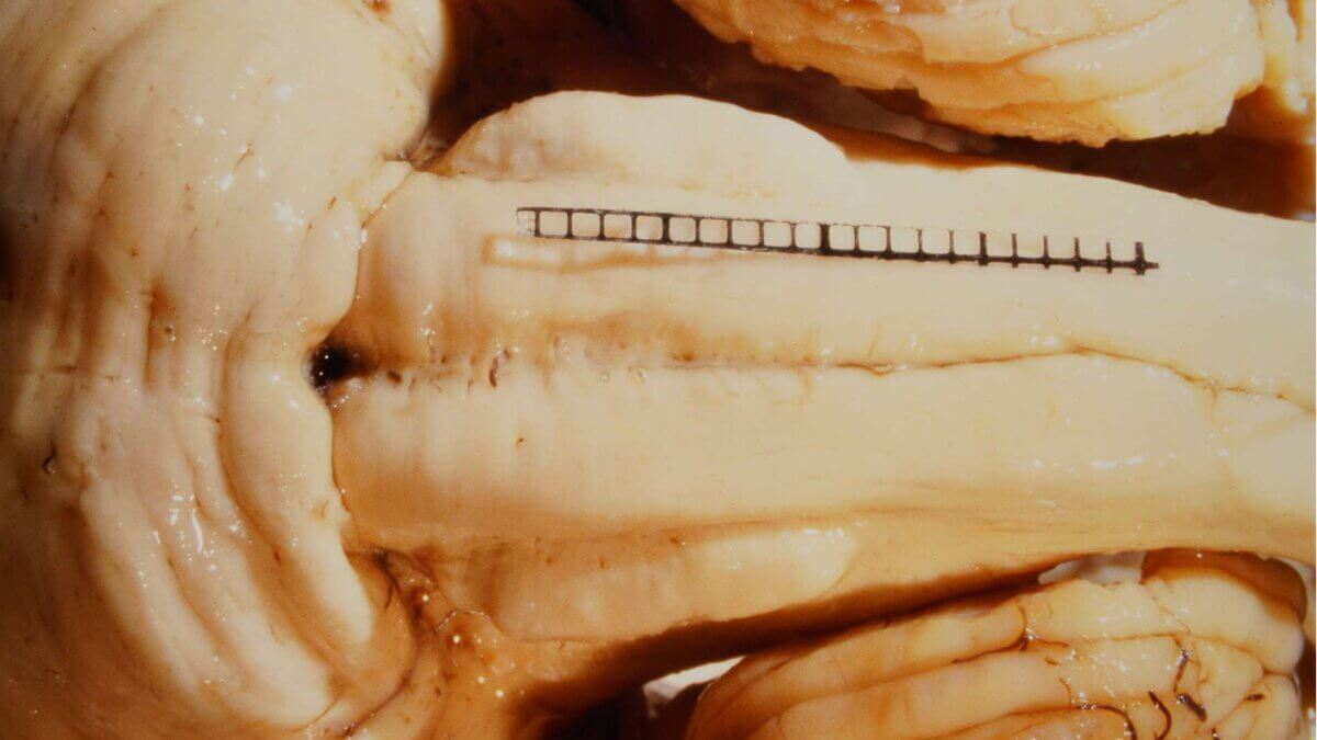 Medulla oblangata