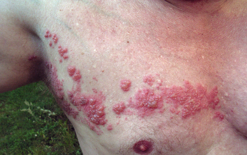 herpes_zoster_chest-1024x644_original.jp
