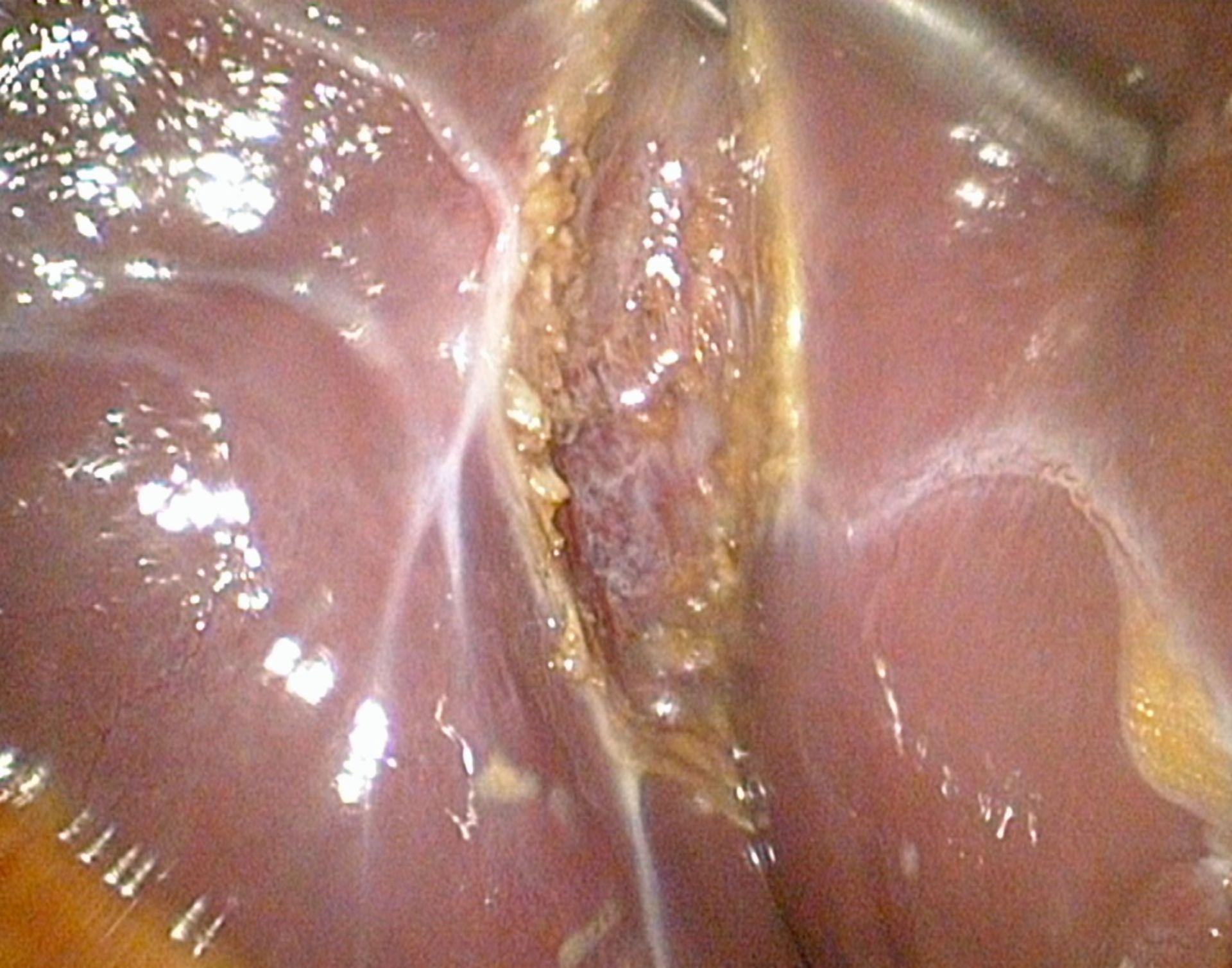 Gallenblasenbett- Zustand nach laparoskopischer Cholecystektomie