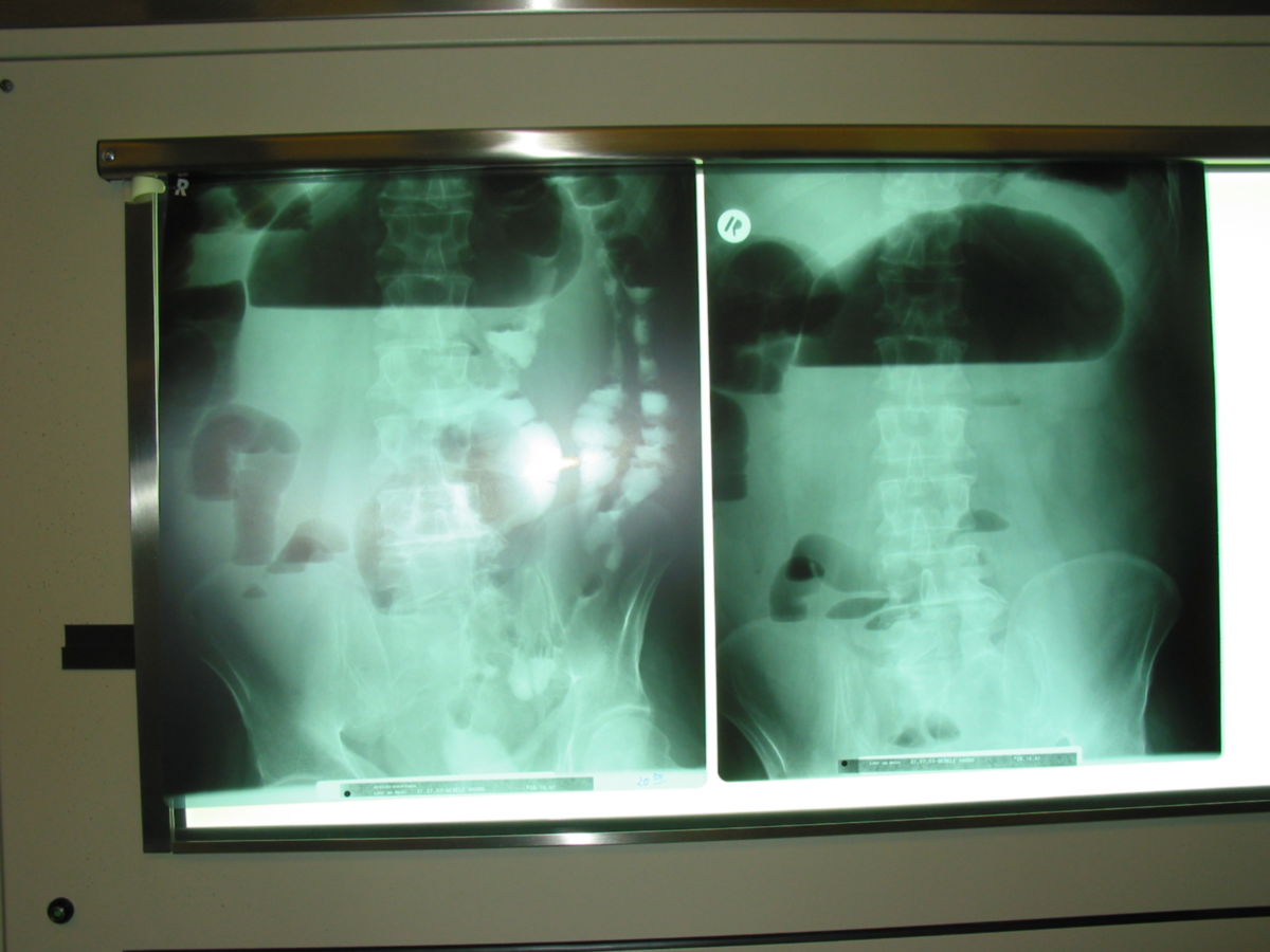 Zoekumvolvulus - Röntgenbild