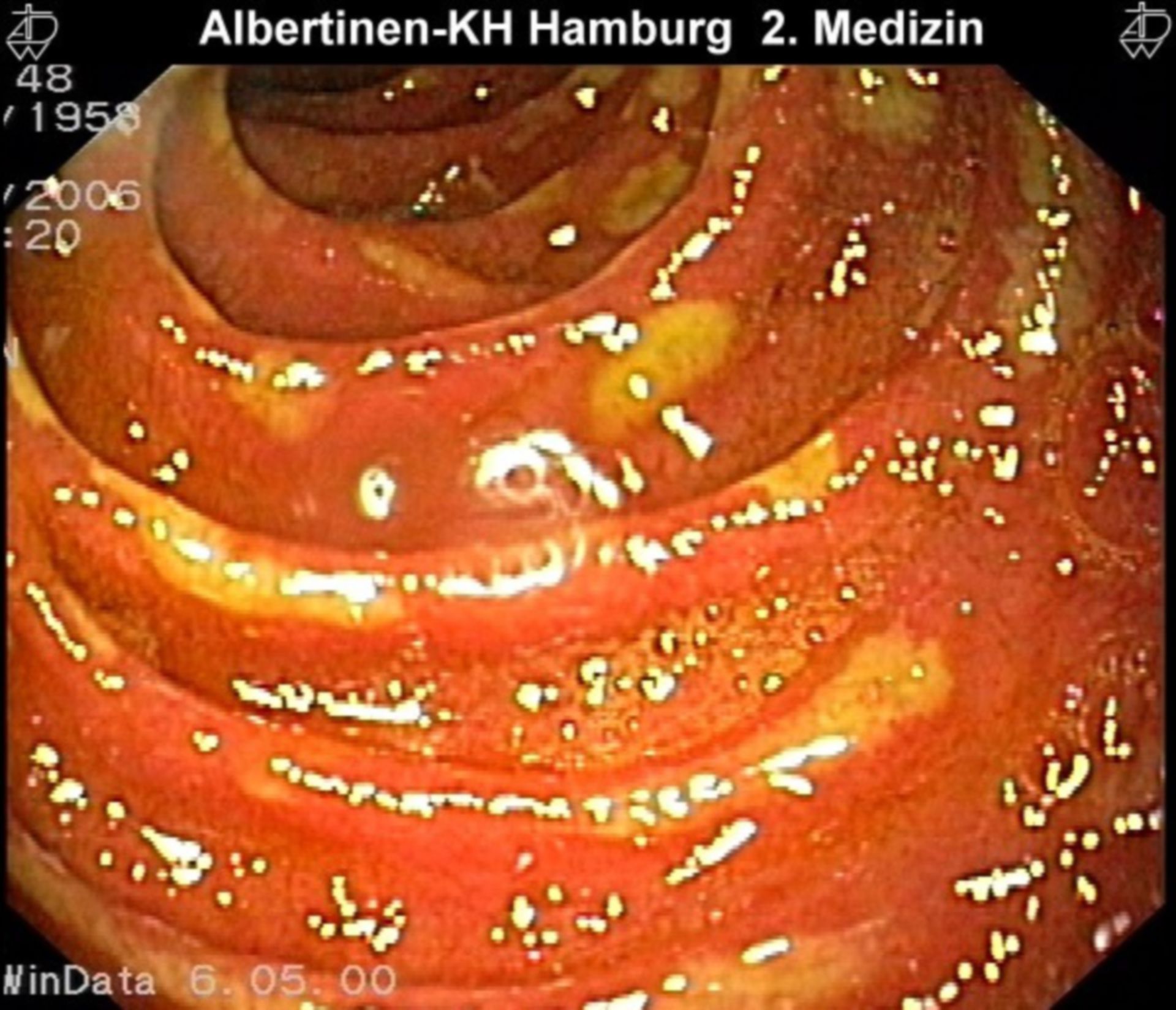 Multiple-Ulc-Duodenum