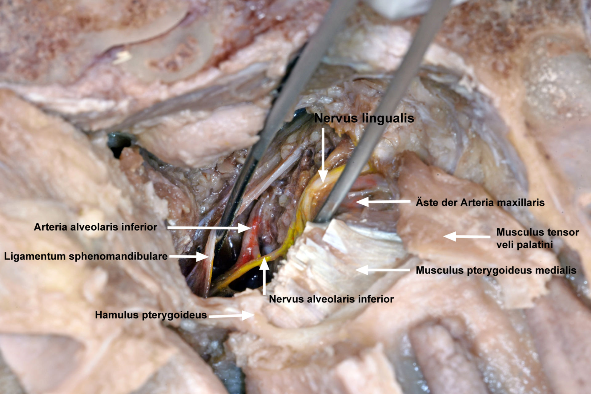 Spatium pterygomandibulare