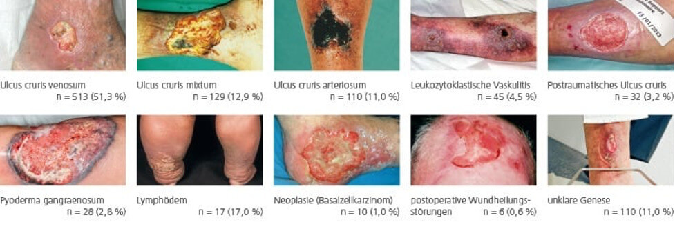 beispiele_ulcus_crusis_original.jpg