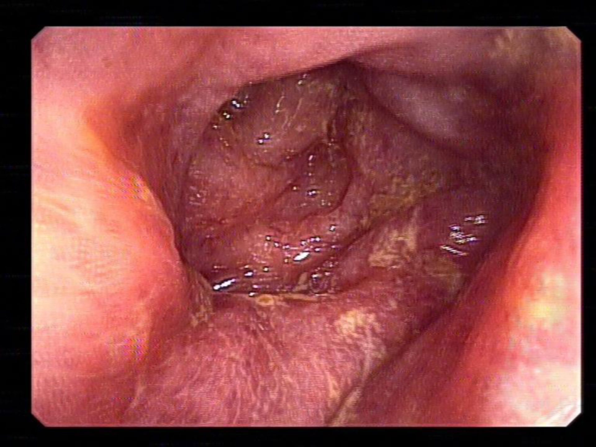 Colitis in EHEC infection