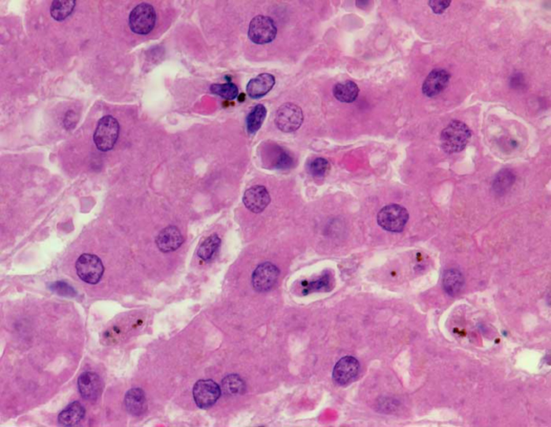 Malaria tropica (Leber, Histologie)