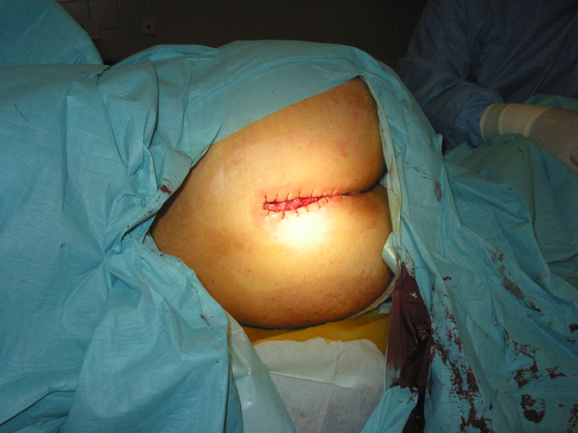 Surgical treatment of a pylonidal cyst