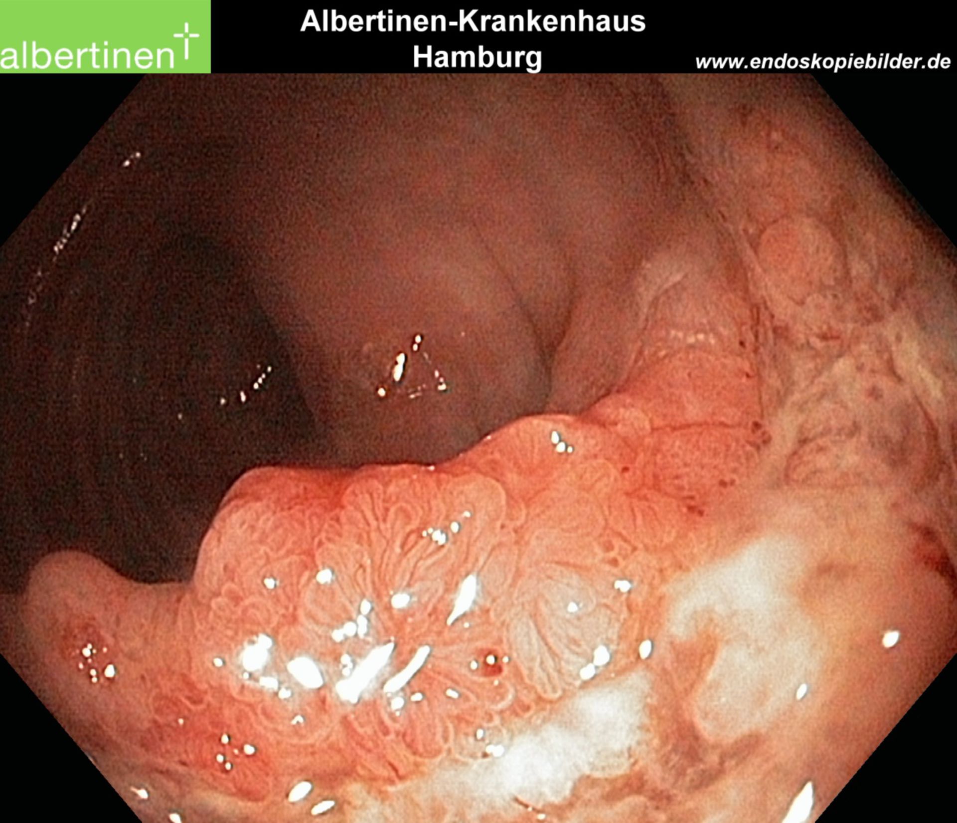 Villöses Adenom nah Colon Endo