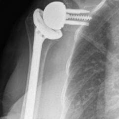 Inverse Schulterprothese - DocCheck Flexikon