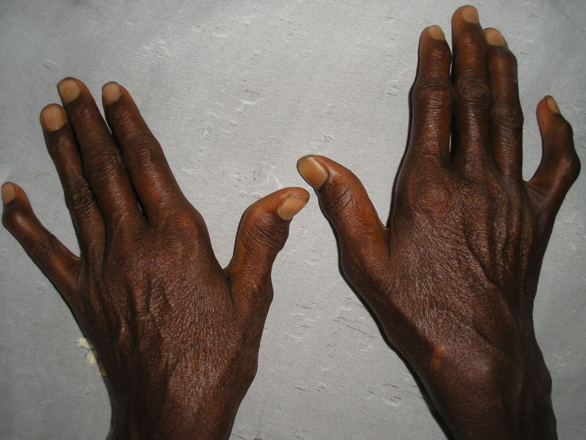 Artrosi della mano