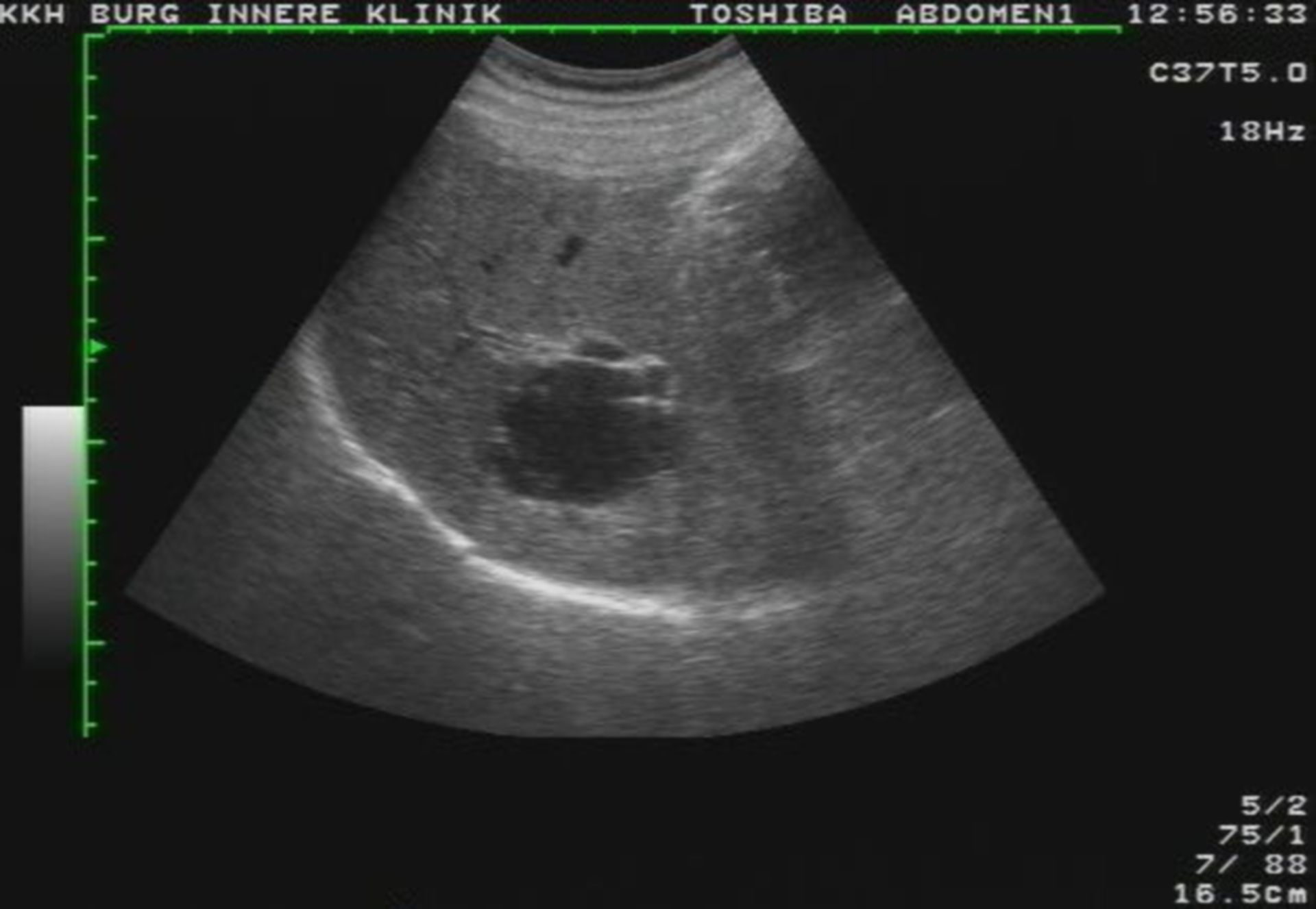 Liver cyst
