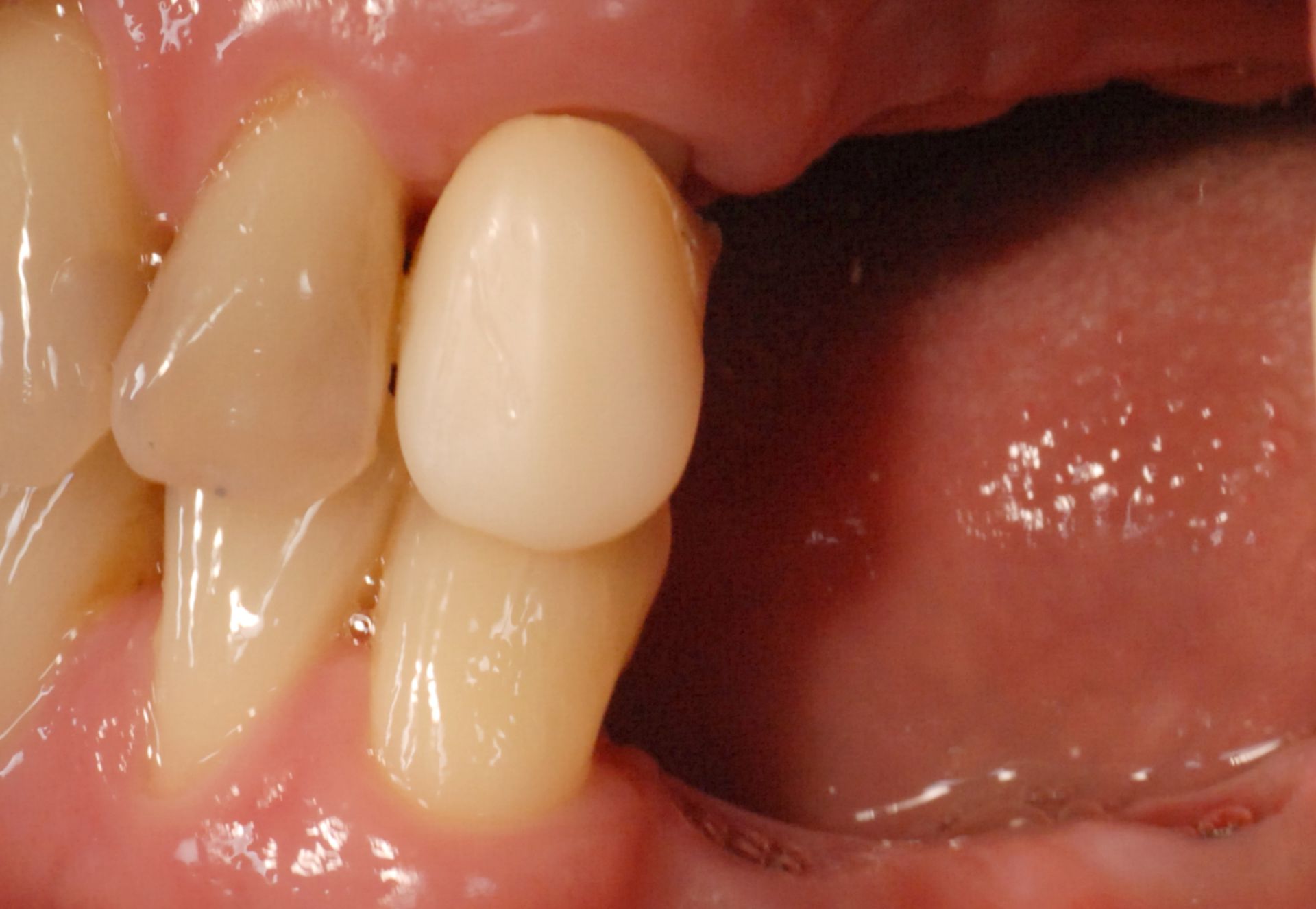 Tooth gaps in upper and lower jaw