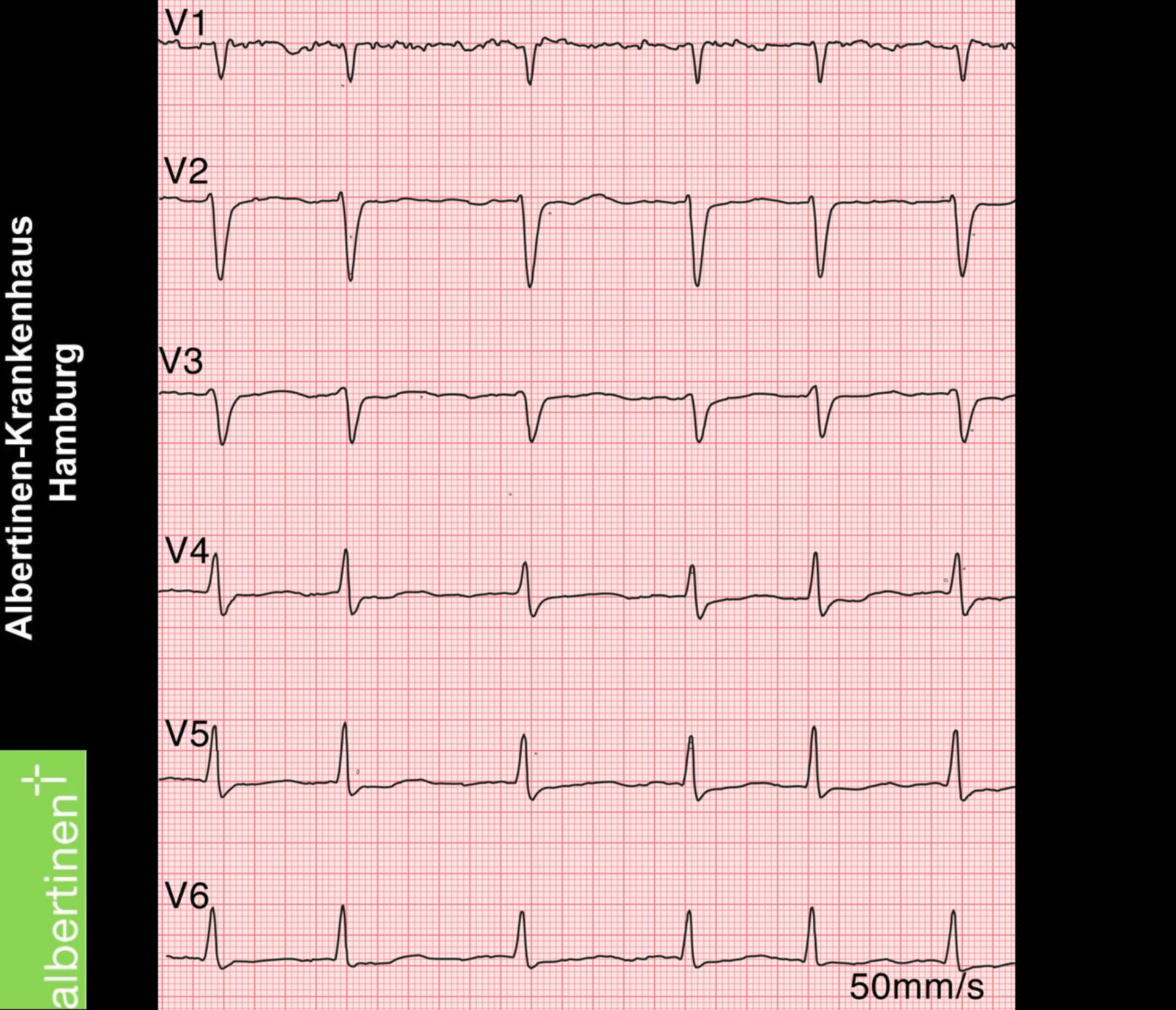 Atrial Fibrillation, Tachycardia (ECG)