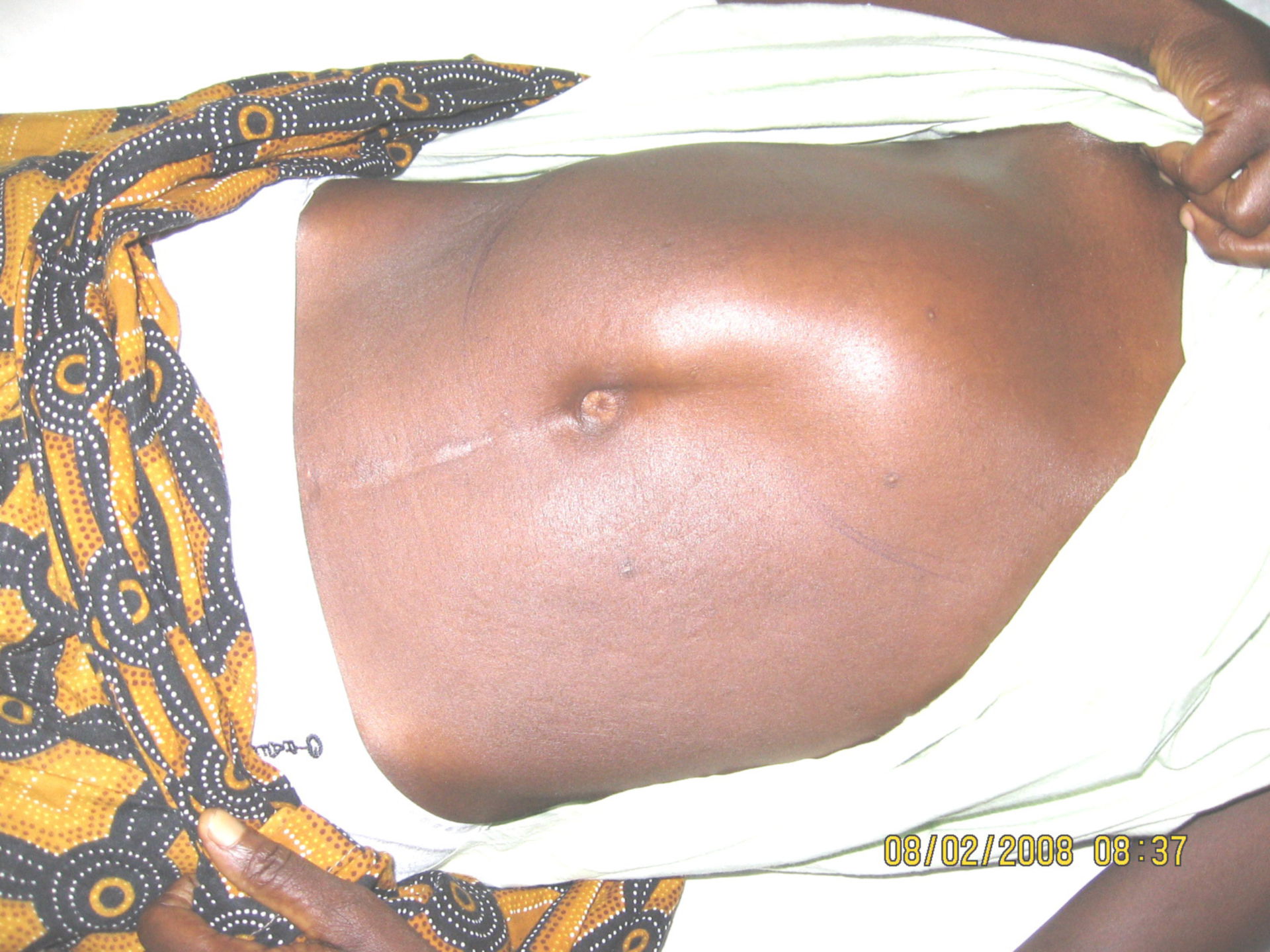 Patient in a ward in Akwatia, Ghana
