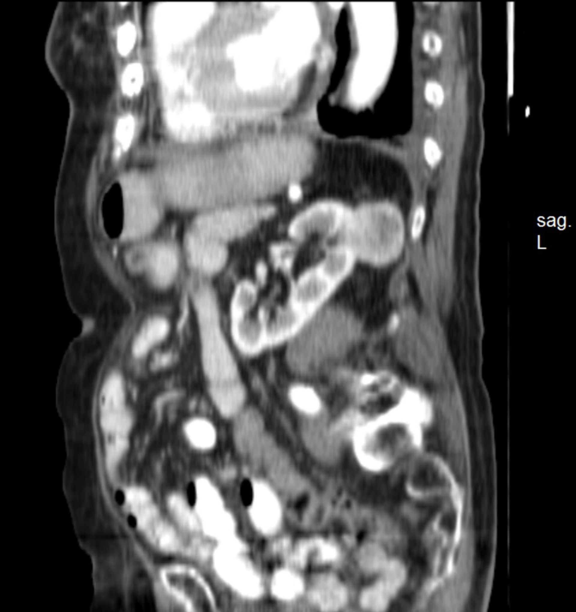 ct_abdomen6: CT des Abdomens in sagittaler Ebene