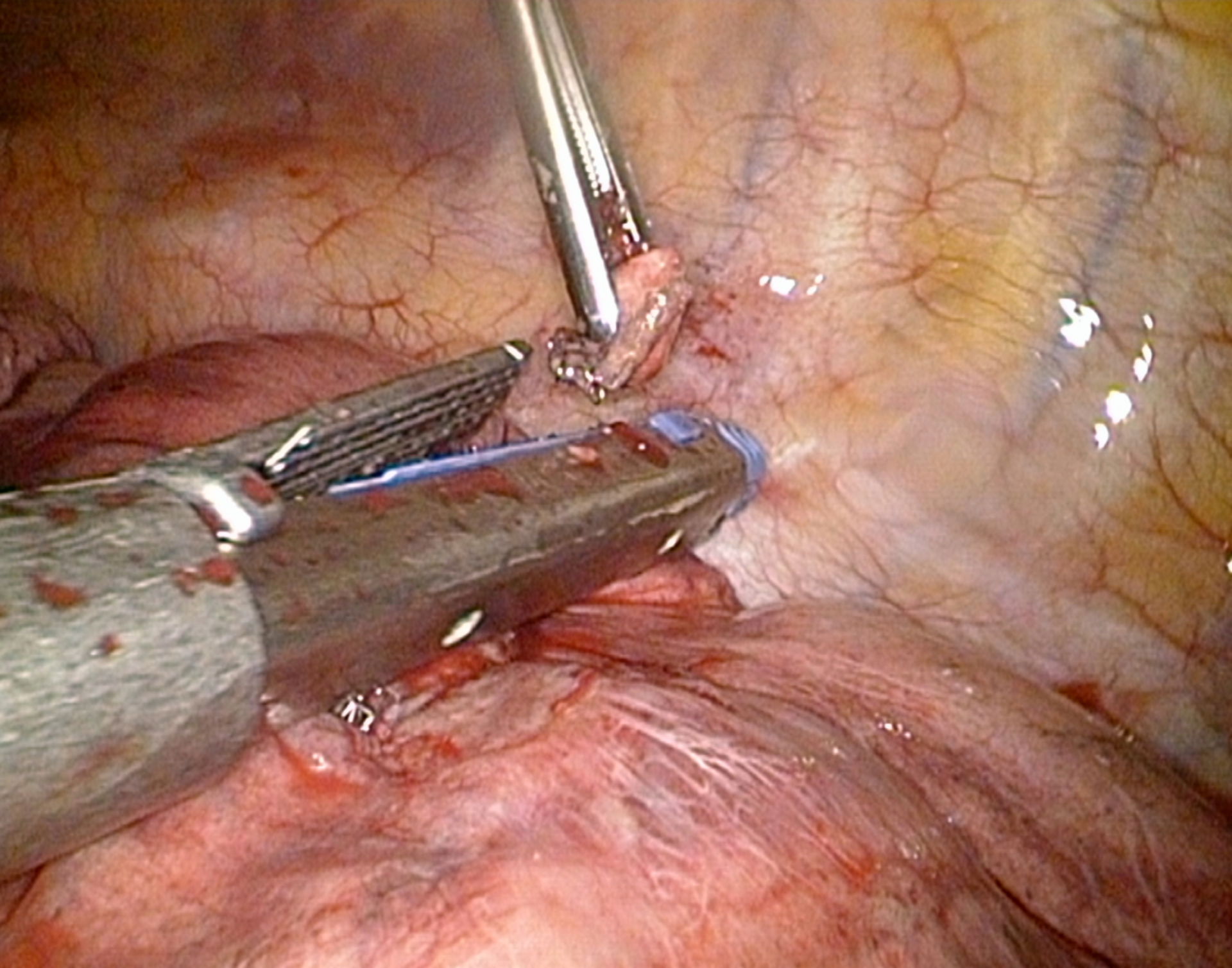 Thorakoskopie Tumorresektion mittels Stapler