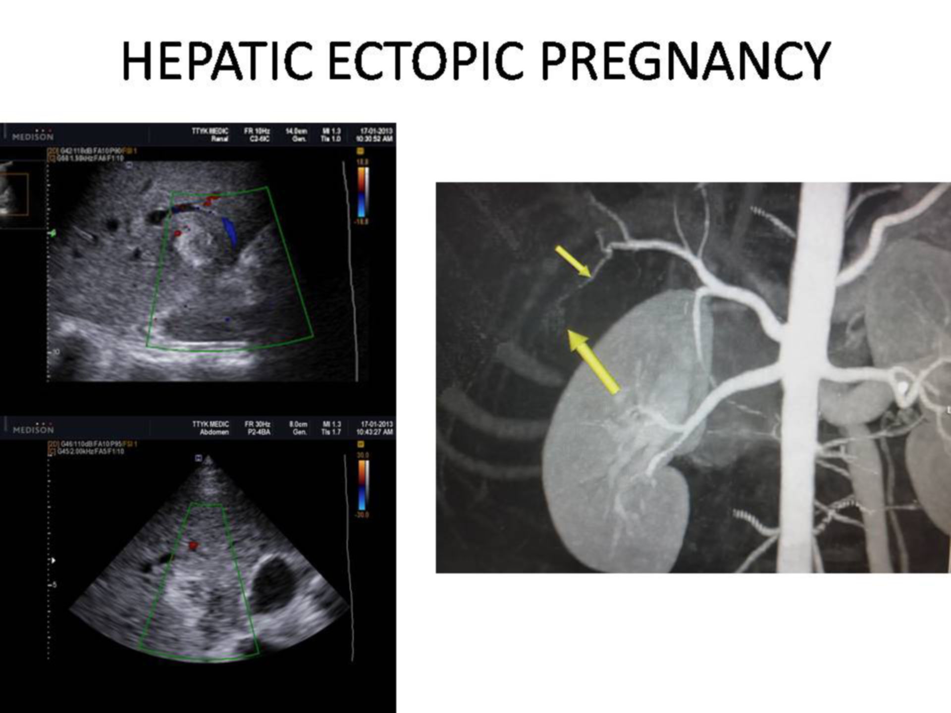 Ektopische Schwangerschaft in der Leber