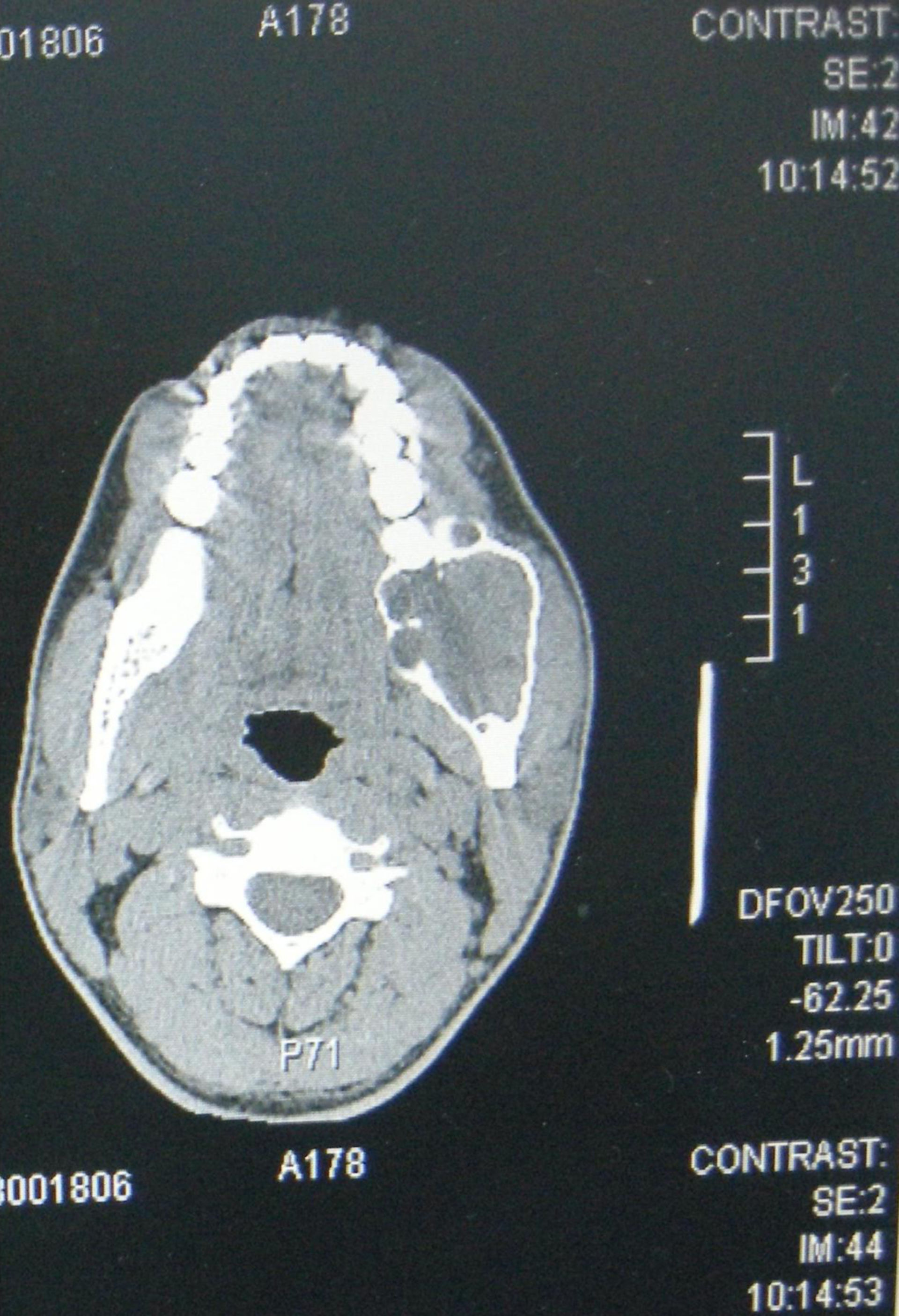 Ameloblastom (CT)
