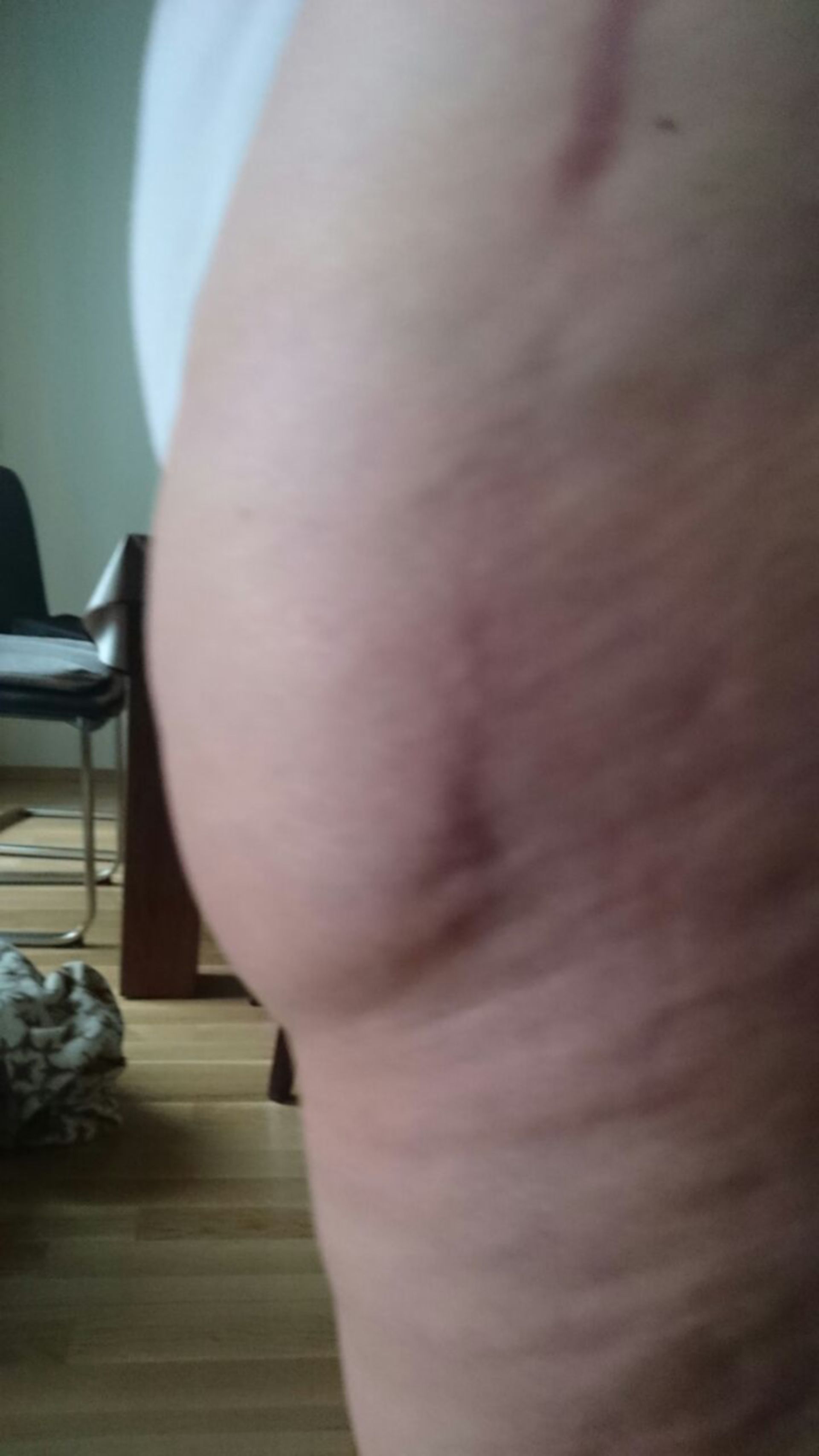 Swelling after hip-TEP 2