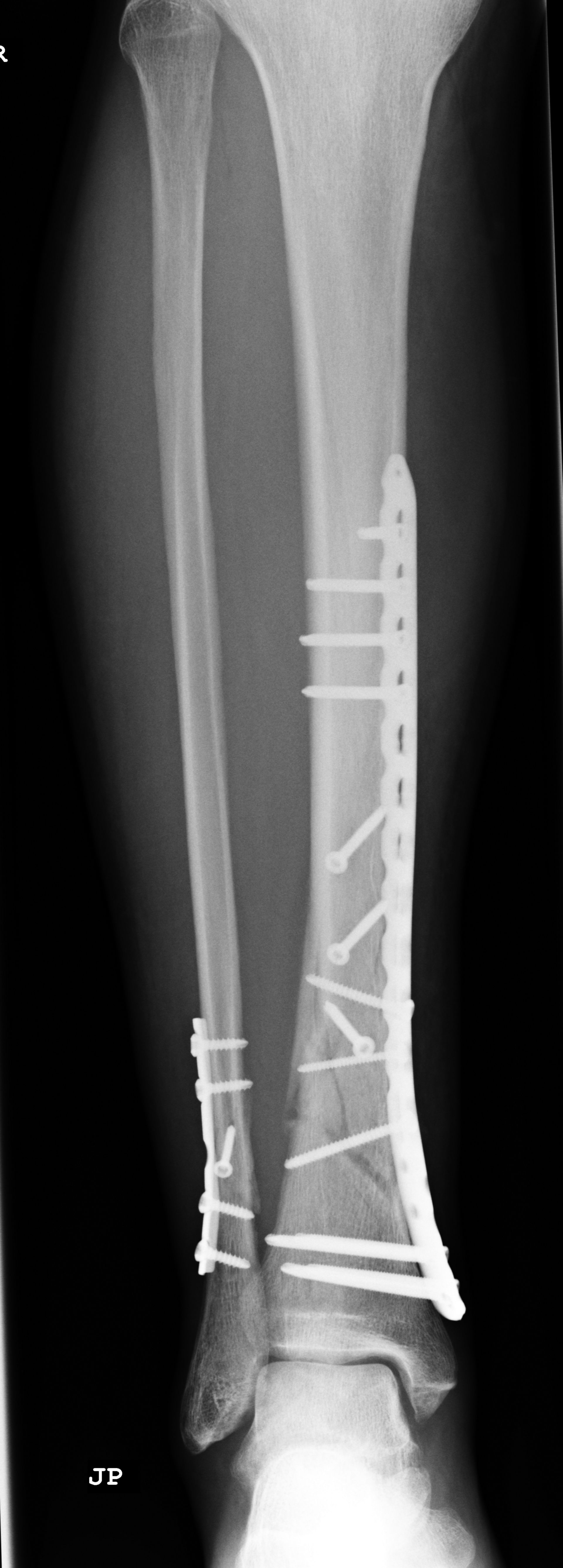 Fracture of the lower leg- osteosynthesis