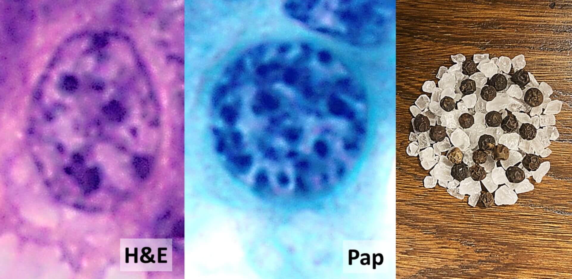 Gut differenzierter neuroendokriner Tumor mit Salz-Pfeffer-Chromatin