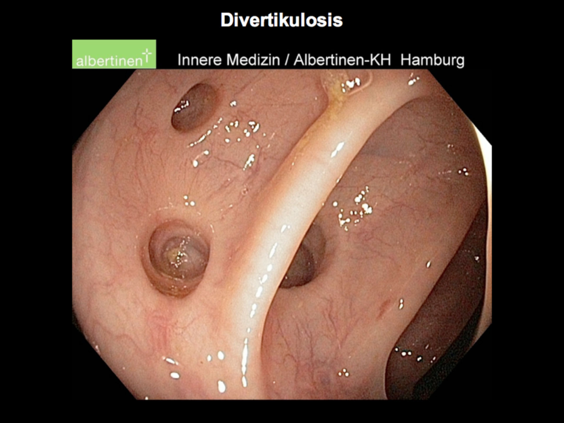 Divertikulose (Endoskopie)
