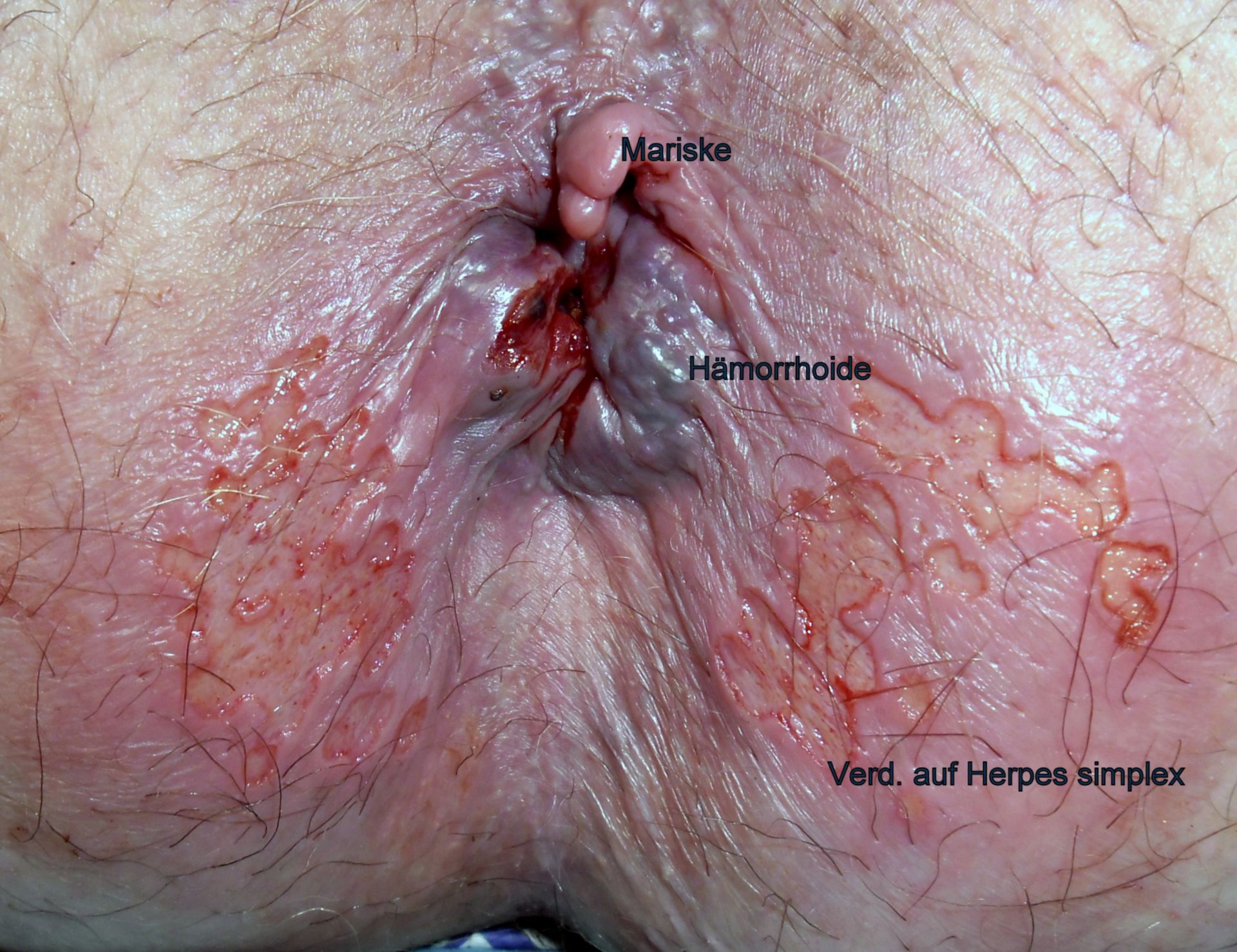 Herpes simplex perianal