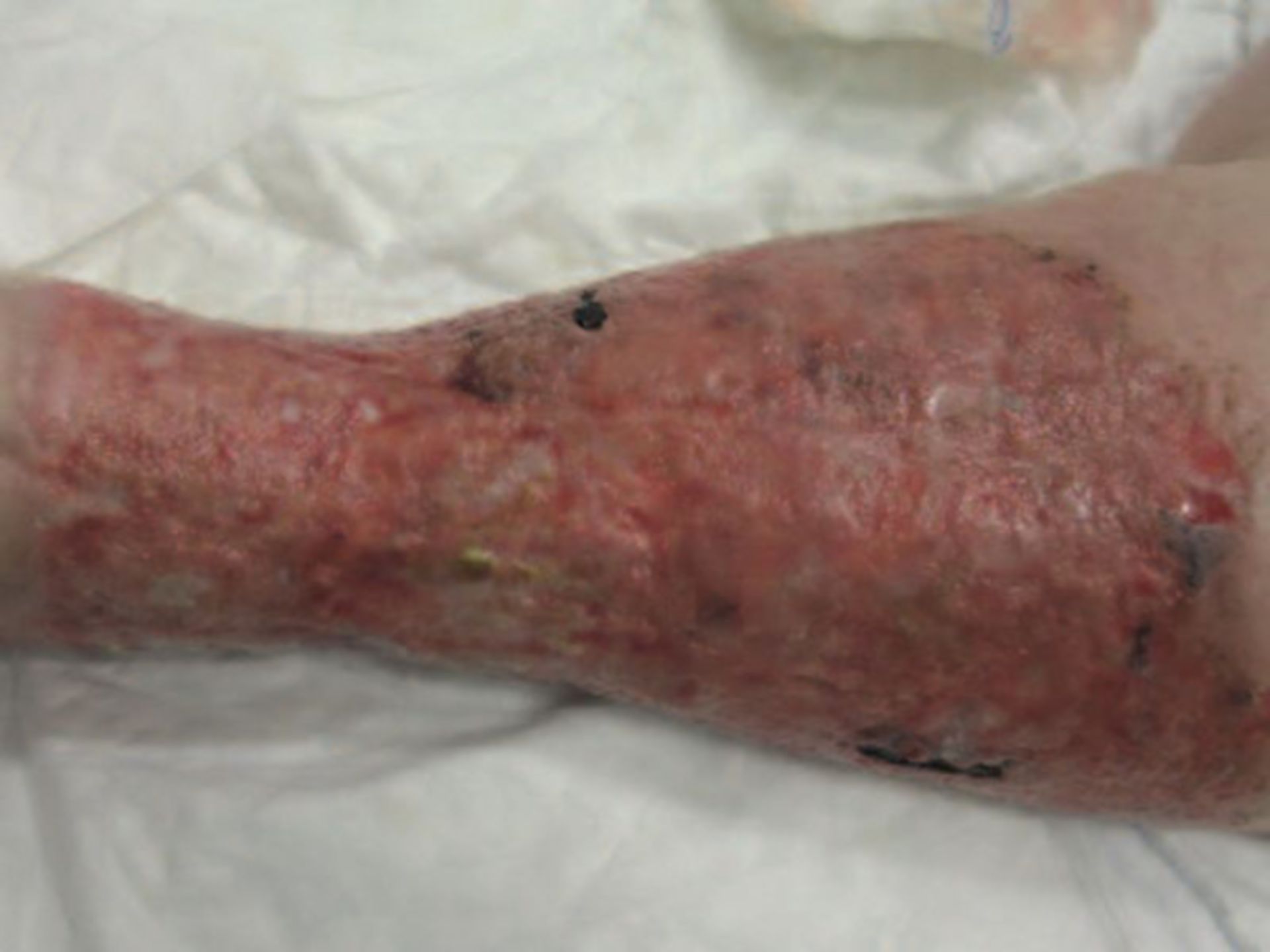 Venous ulcus cruris - before treatment