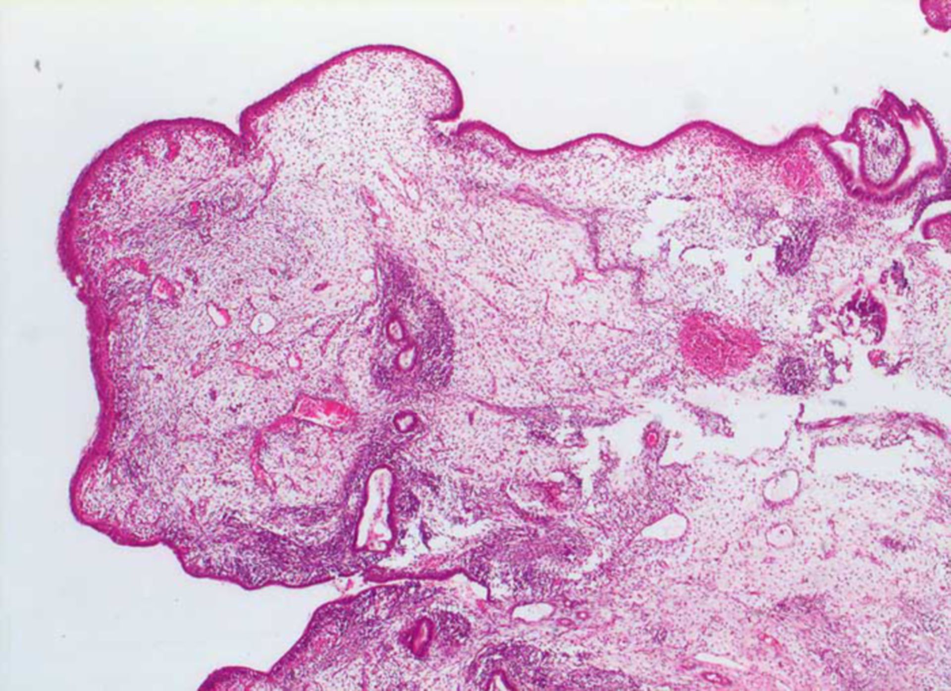 Botryoid sarcoma of the vagina