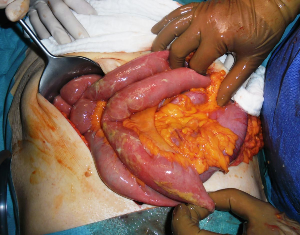 Kotige Peritonitis bei Colonperforation-M.Crohn