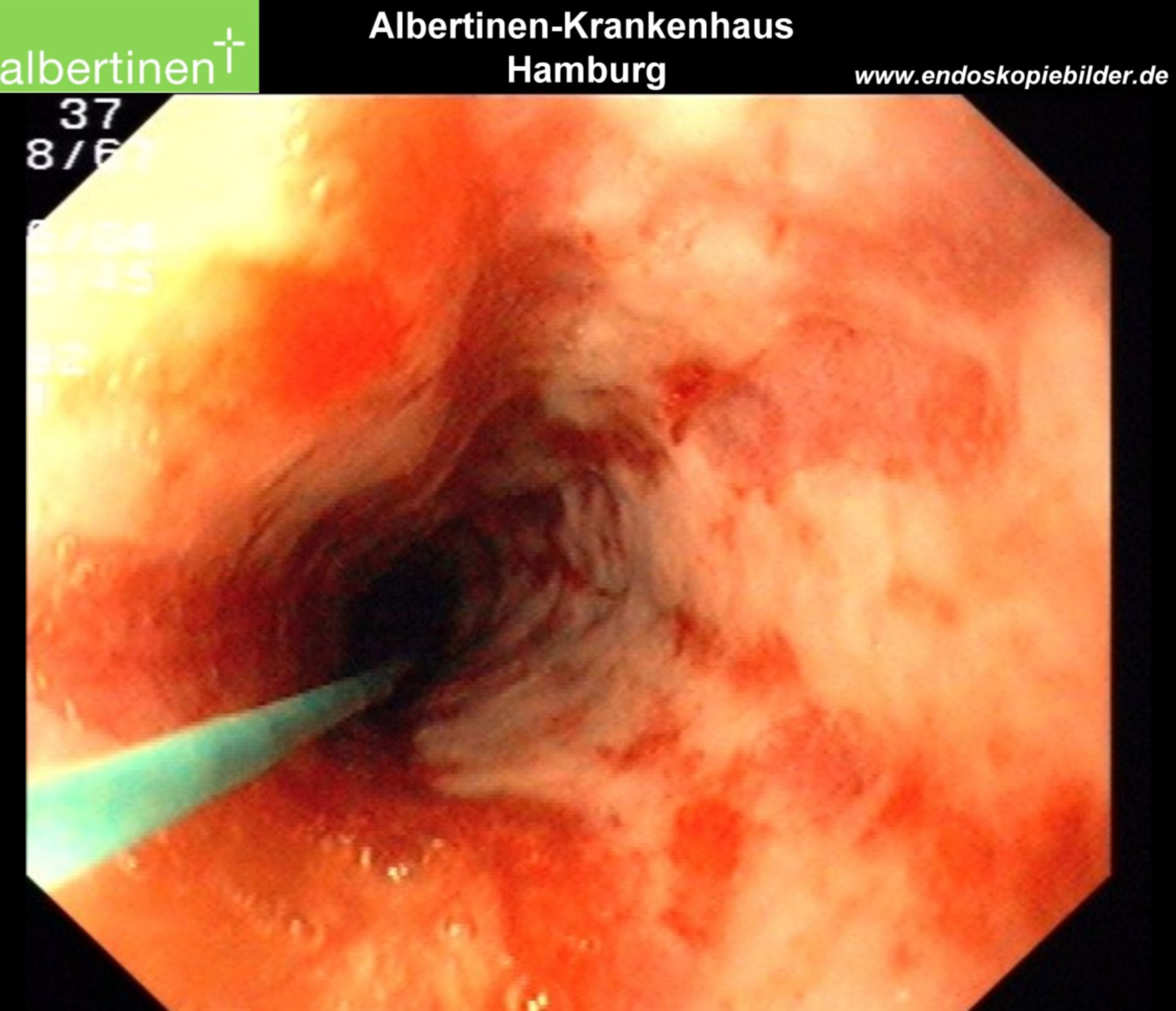 Esophagus: Alkali burn