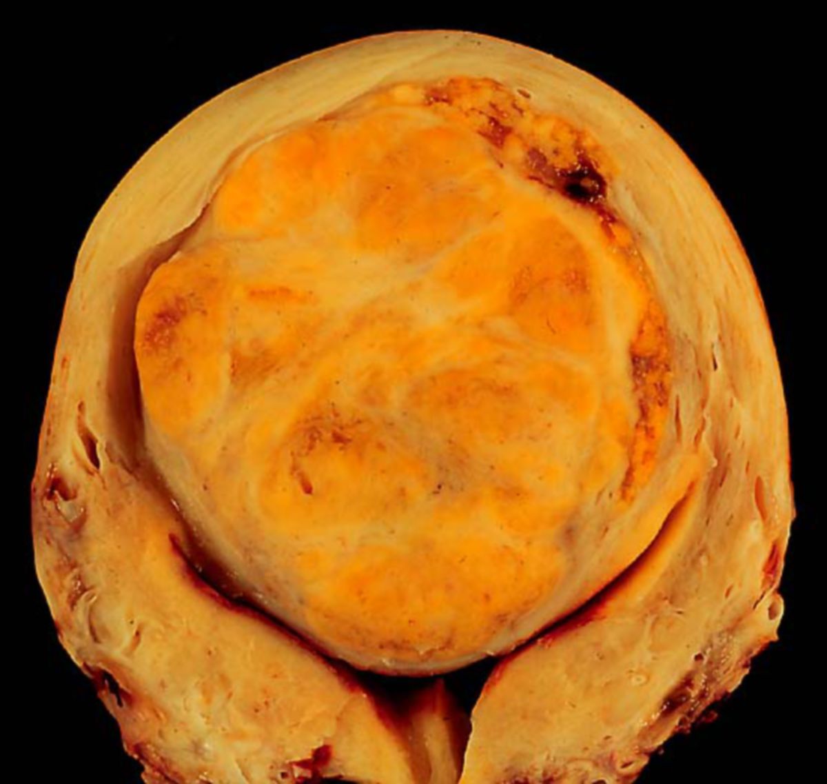 Uterus-Leiomyom (Präparat)