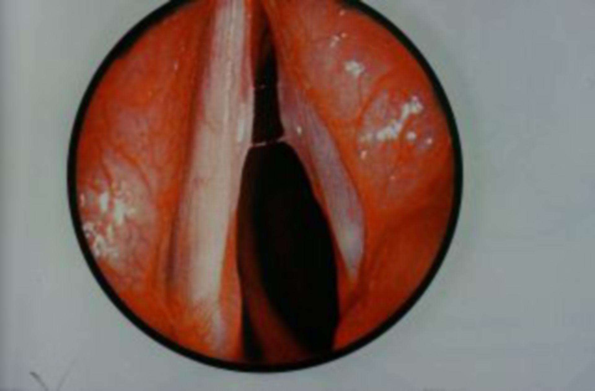 Unilateral vocal cord paralysis