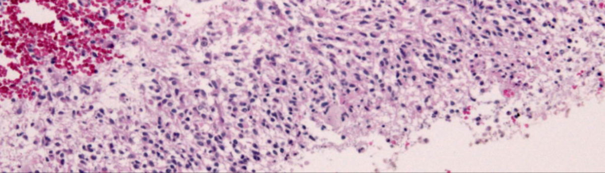 Glioblastom Fortschritt durch neue Therapie DocCheck