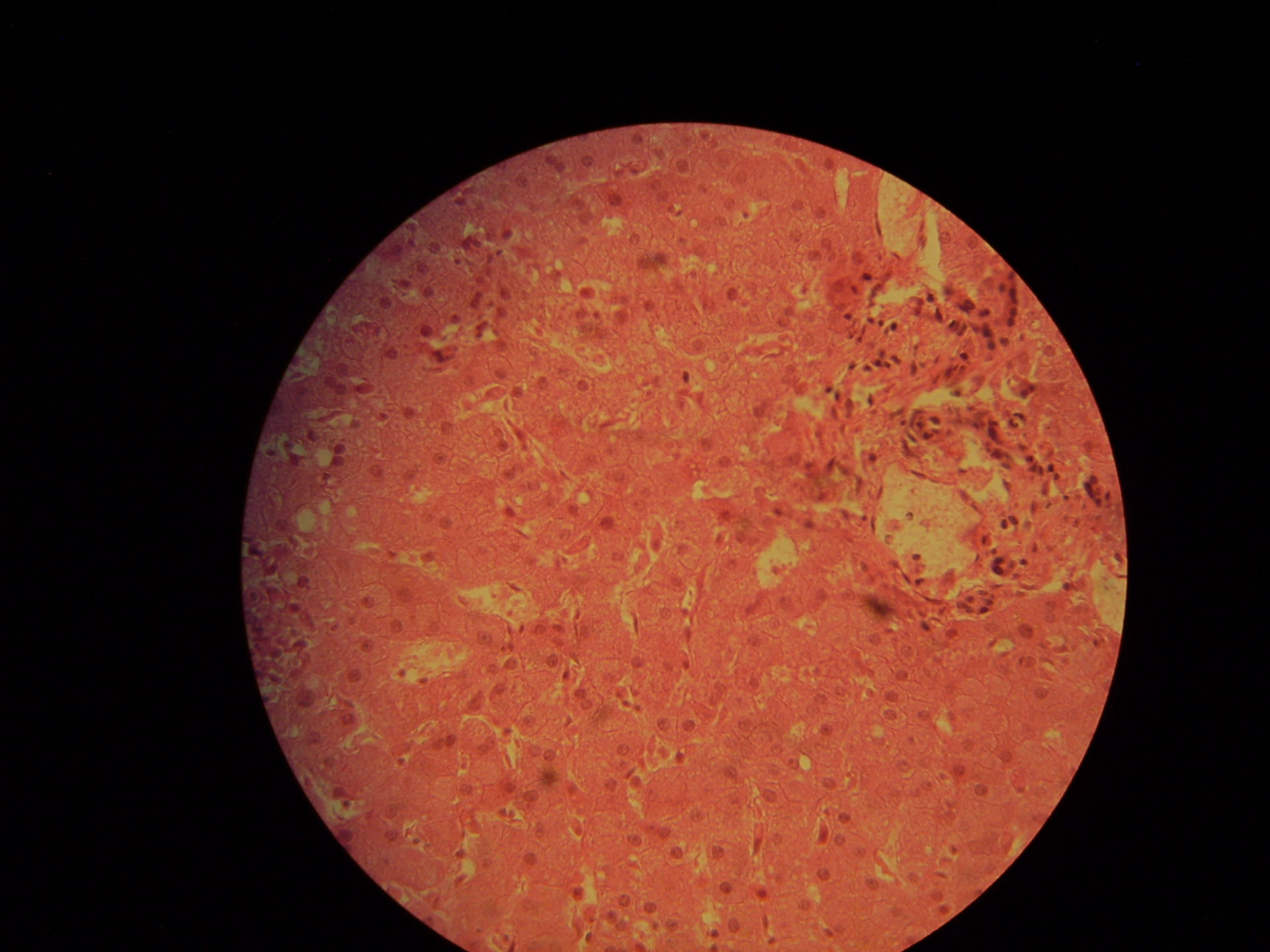 Granulomatous hepatitis in course of  typhus