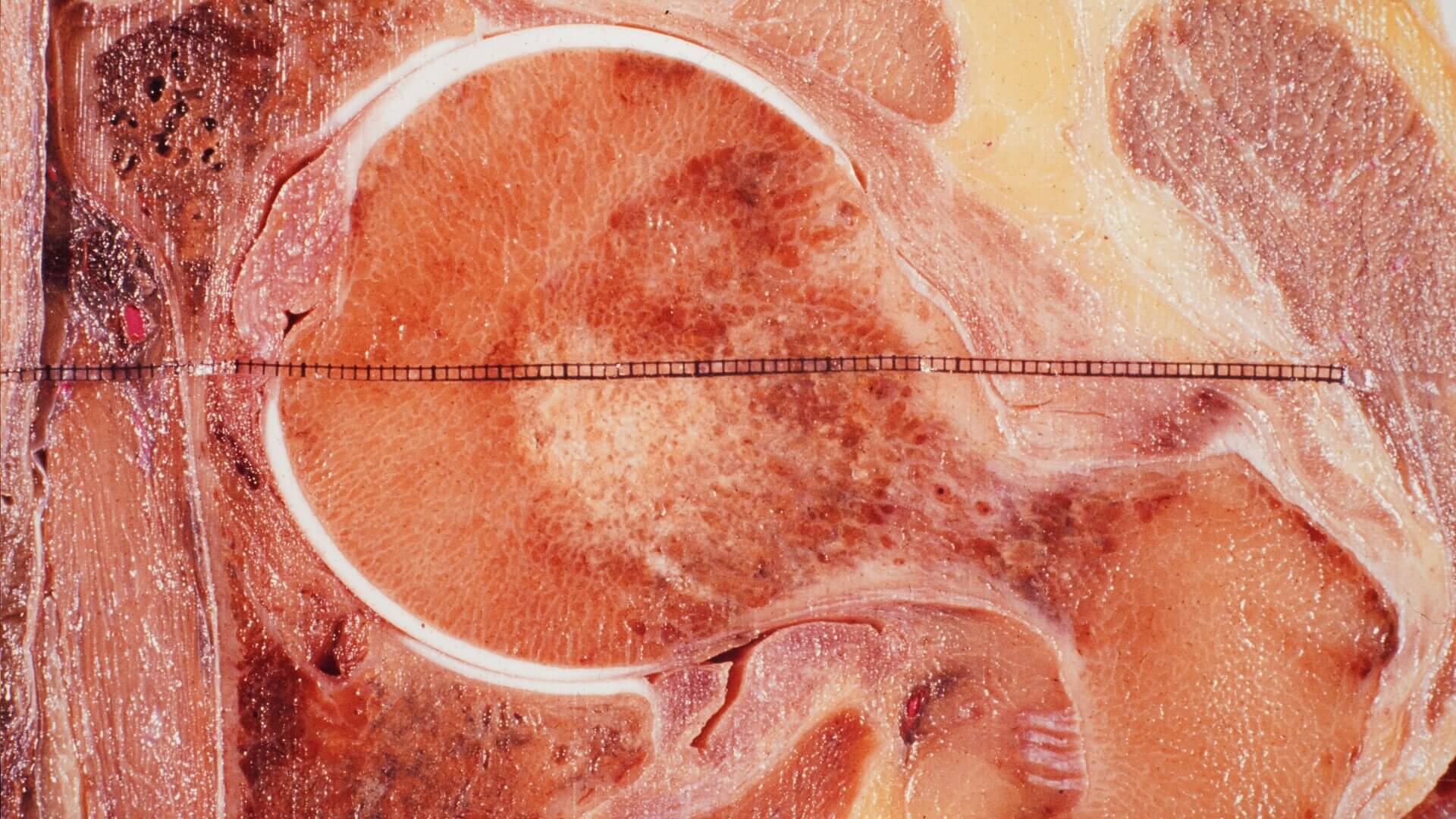 Detailansicht Caput femoris