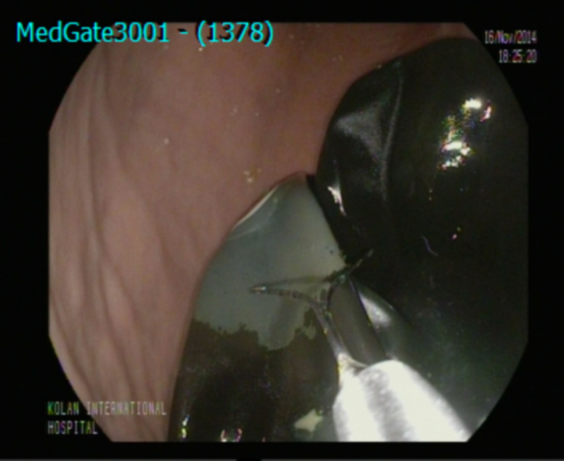 Grasping of a perforated and totally emptied intragastric silicone balloon