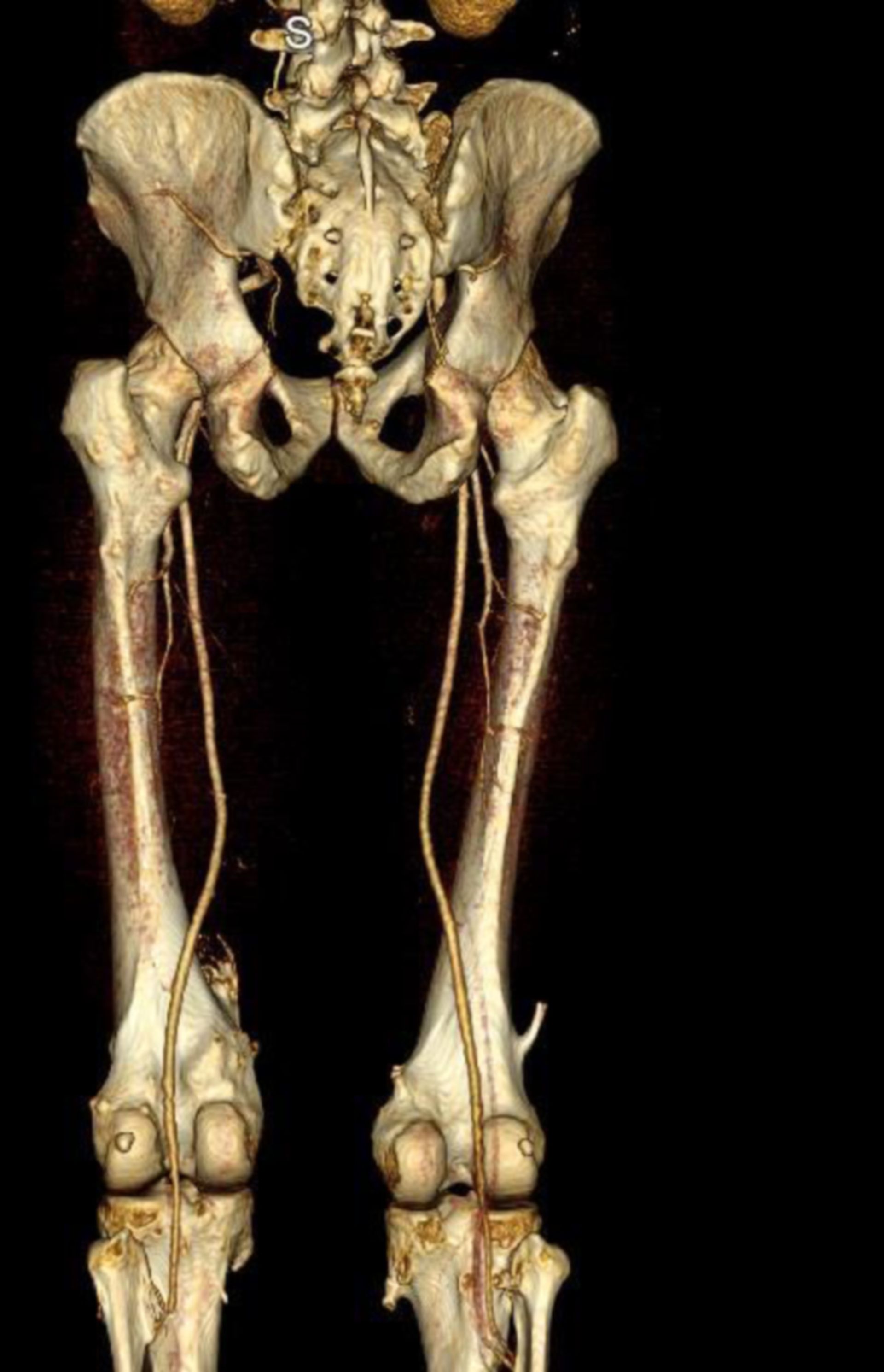 Osteoid Osteom am Knie
