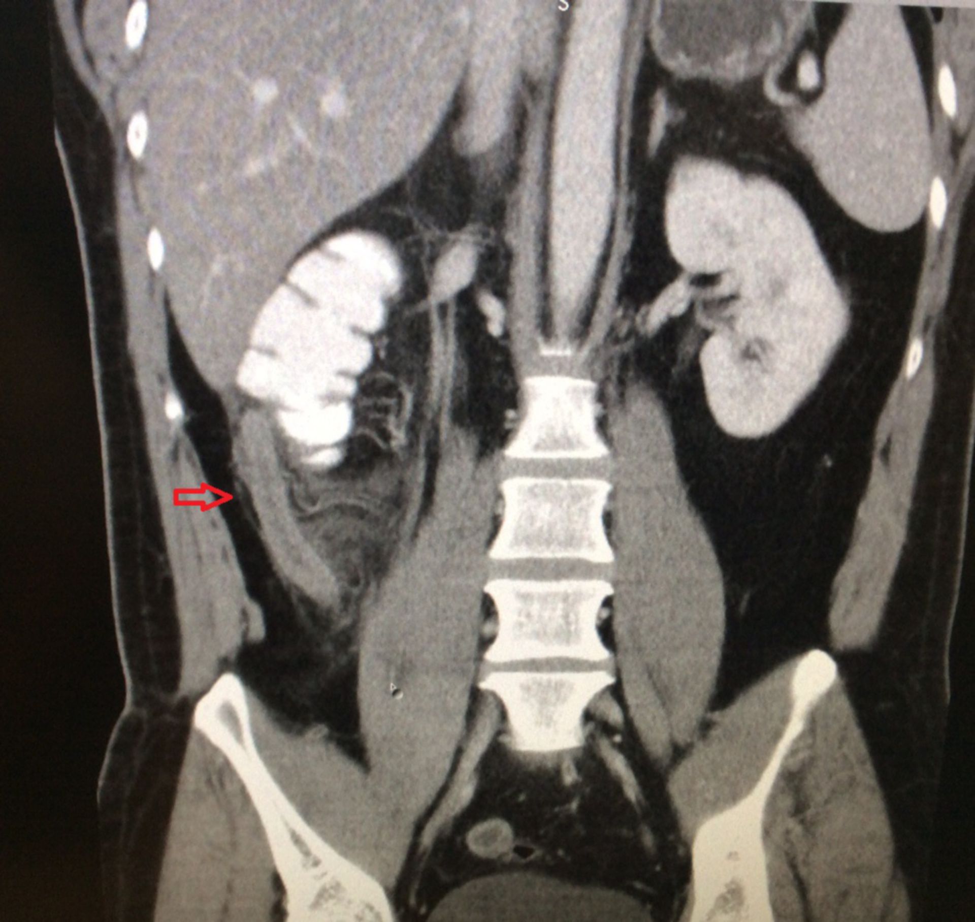 Abdominal CT: inflammation of the appendix