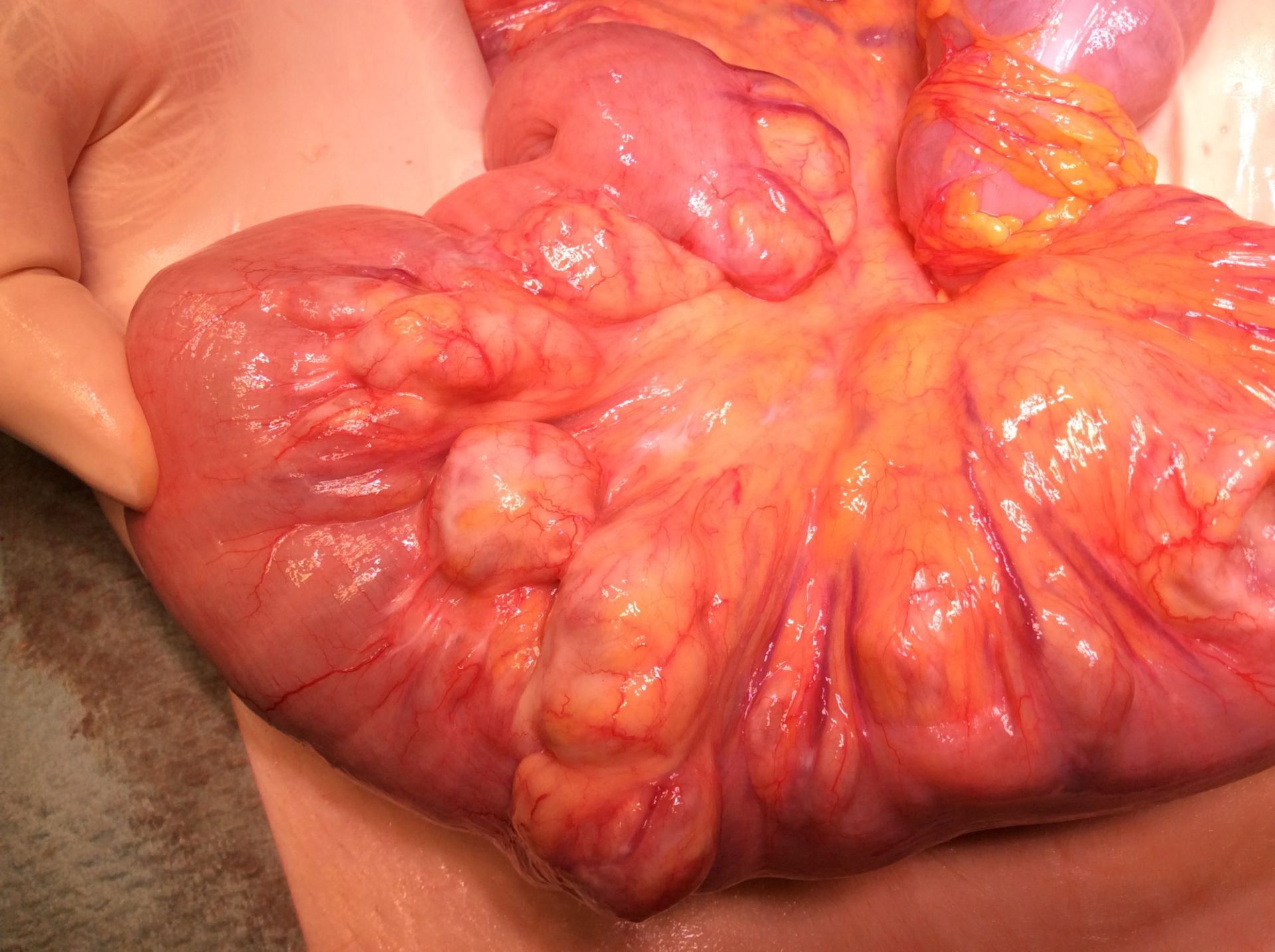 Massive diverticula of small intestine with inflammation (4)
