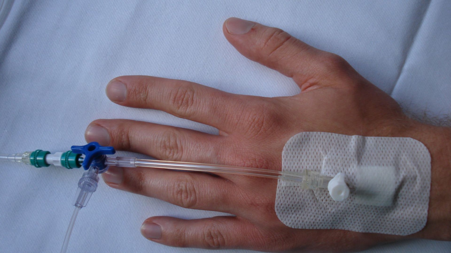 Peripheral vein catheter, 17 Gauge, 1,5mm