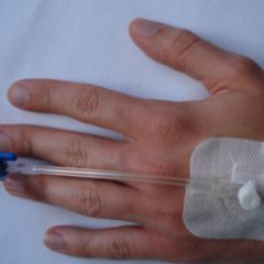 Peripherer Venenkatheter DocCheck Flexikon