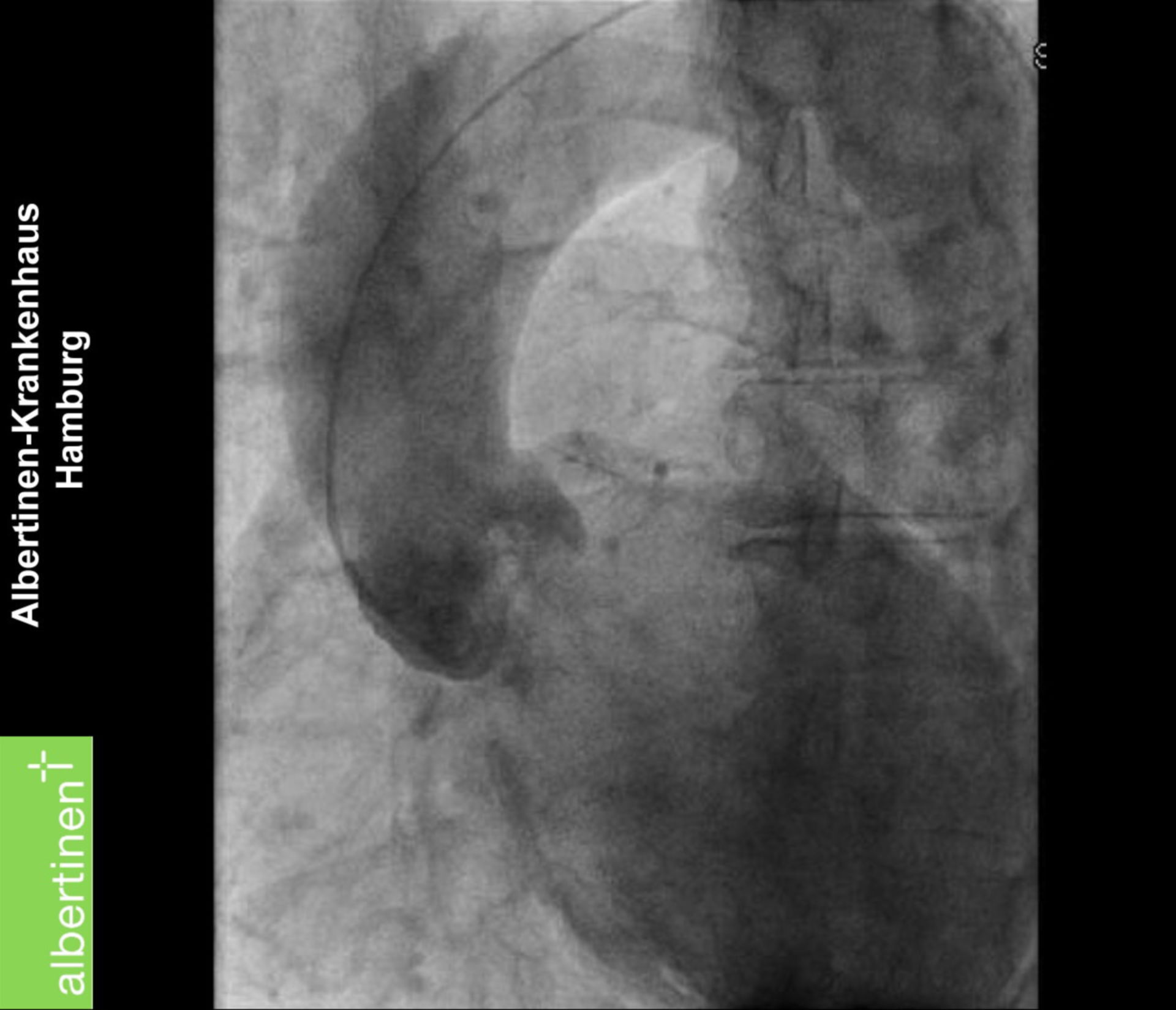 Insufficienza valvolare aortica (aortografia)