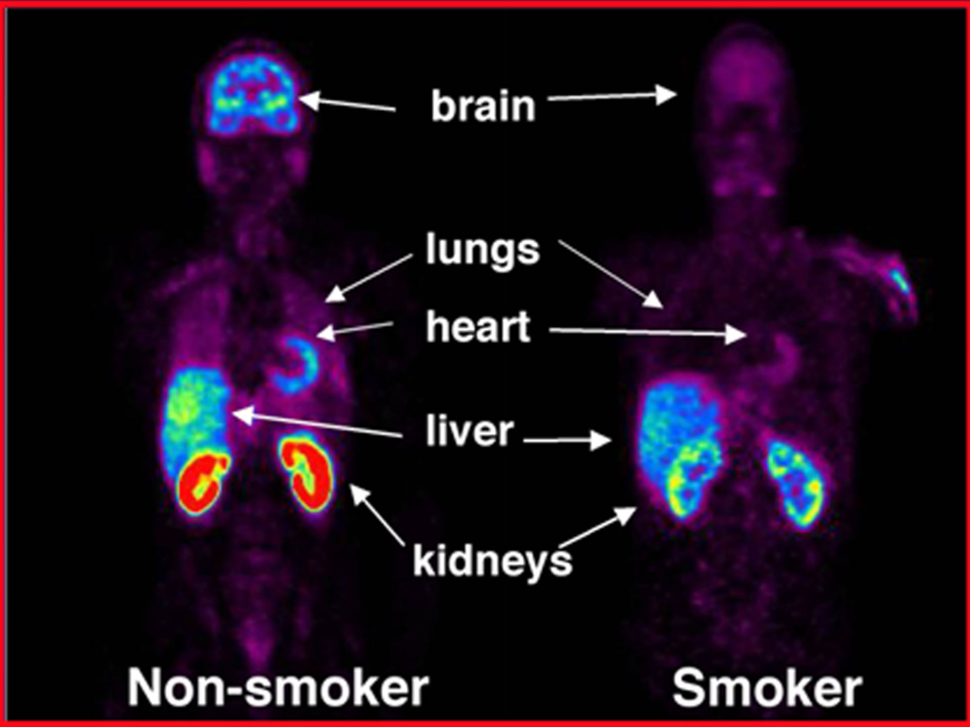 Imaging Study Reveals Effect of Smoking on Peripheral Organs