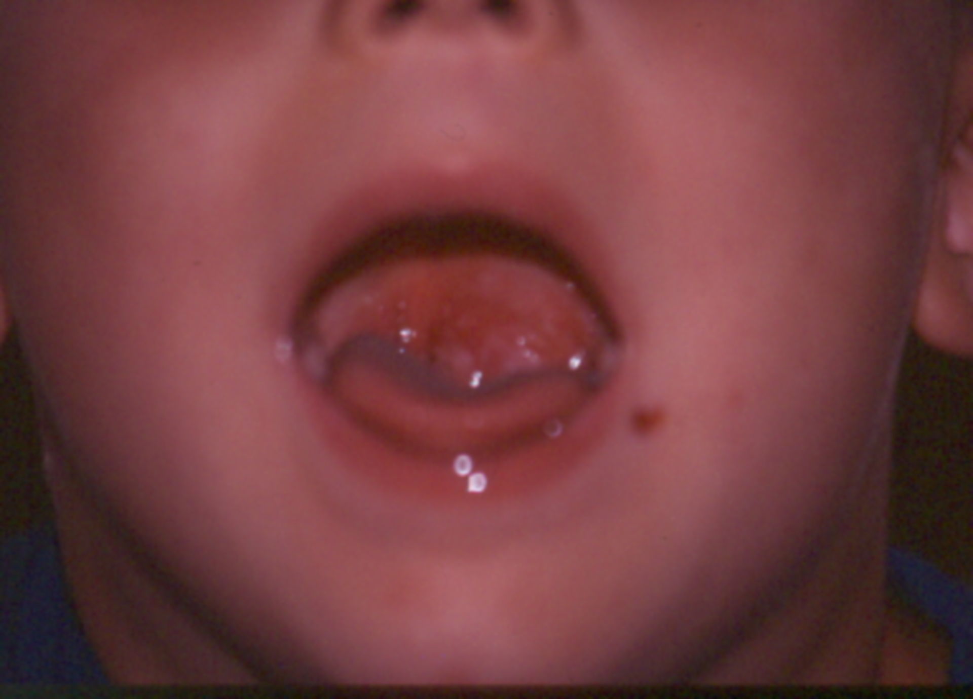 Tonsillarabszess