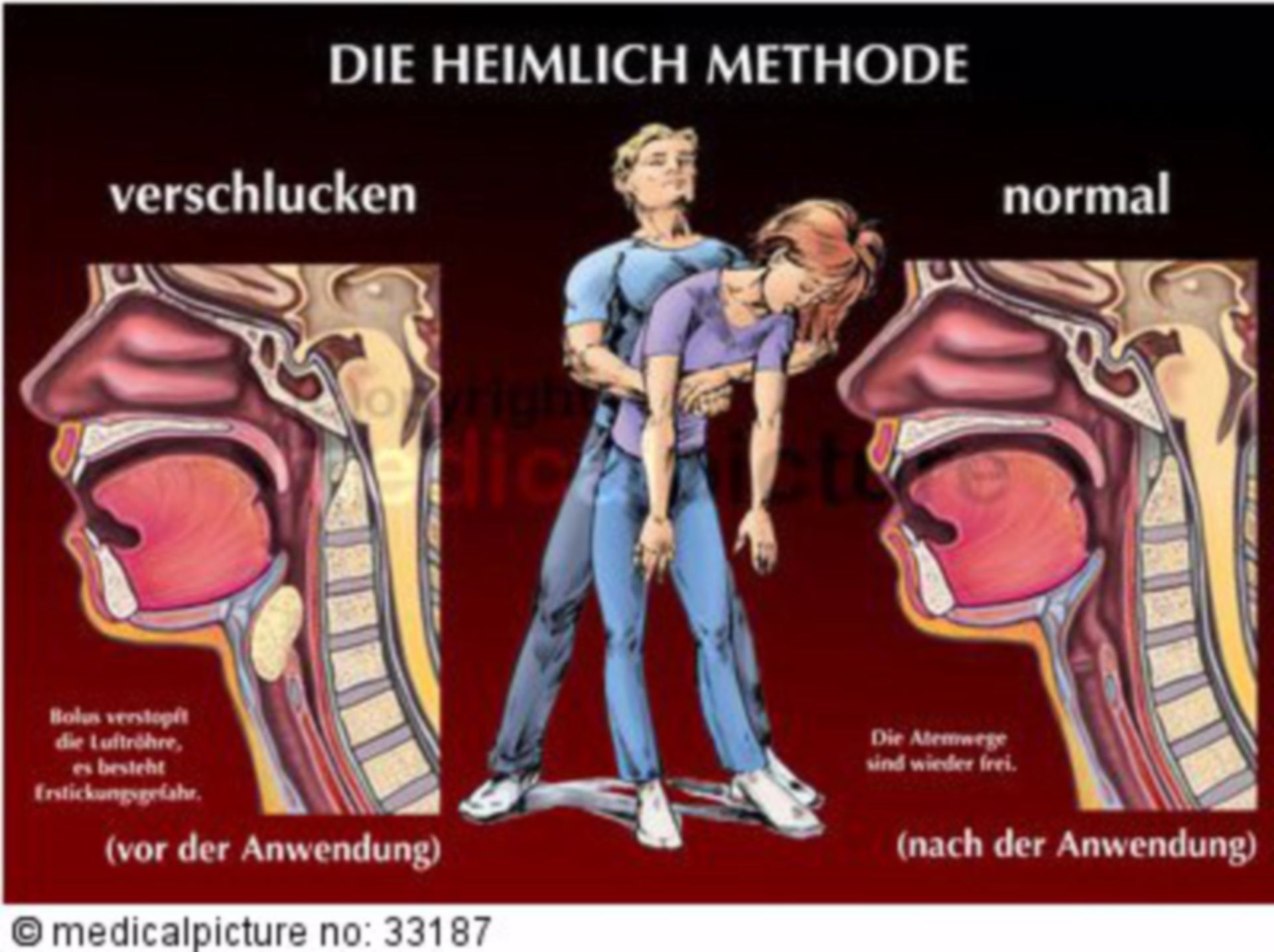  Heimlich-Handgriff Illustration 
