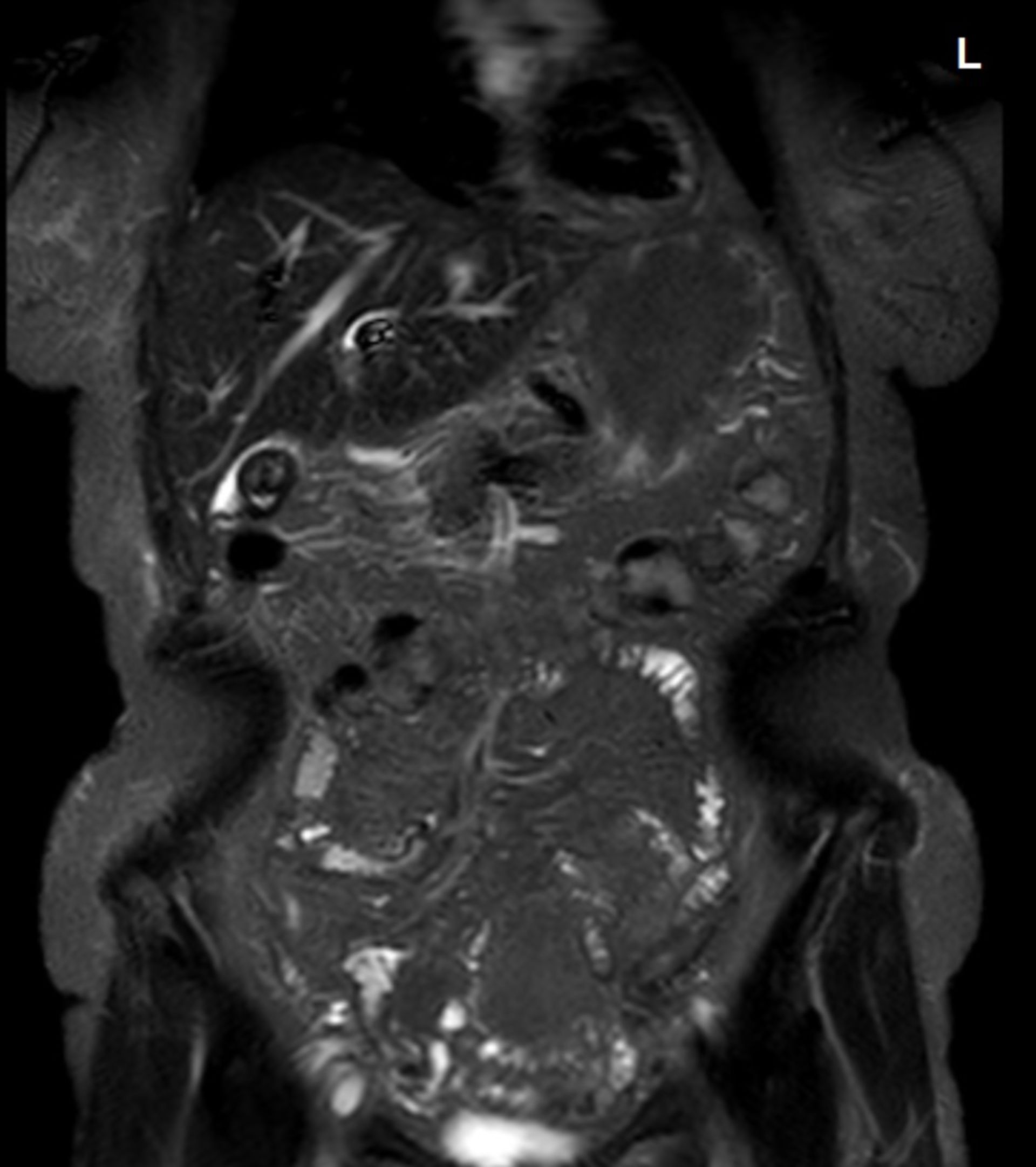 stir_cor1: MRT des Abdomens in frontaler Ebene