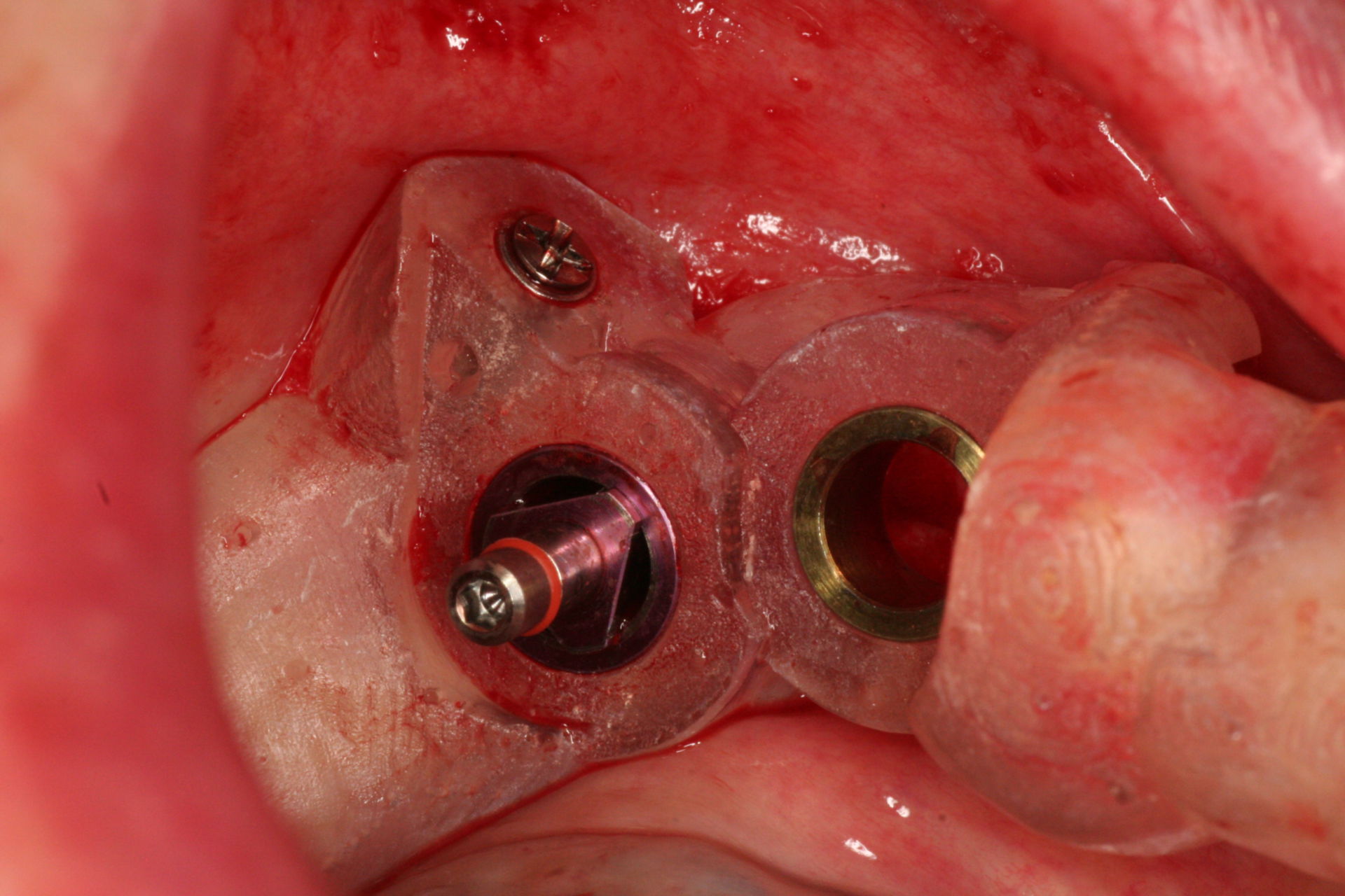 3d Guided Implant Placement