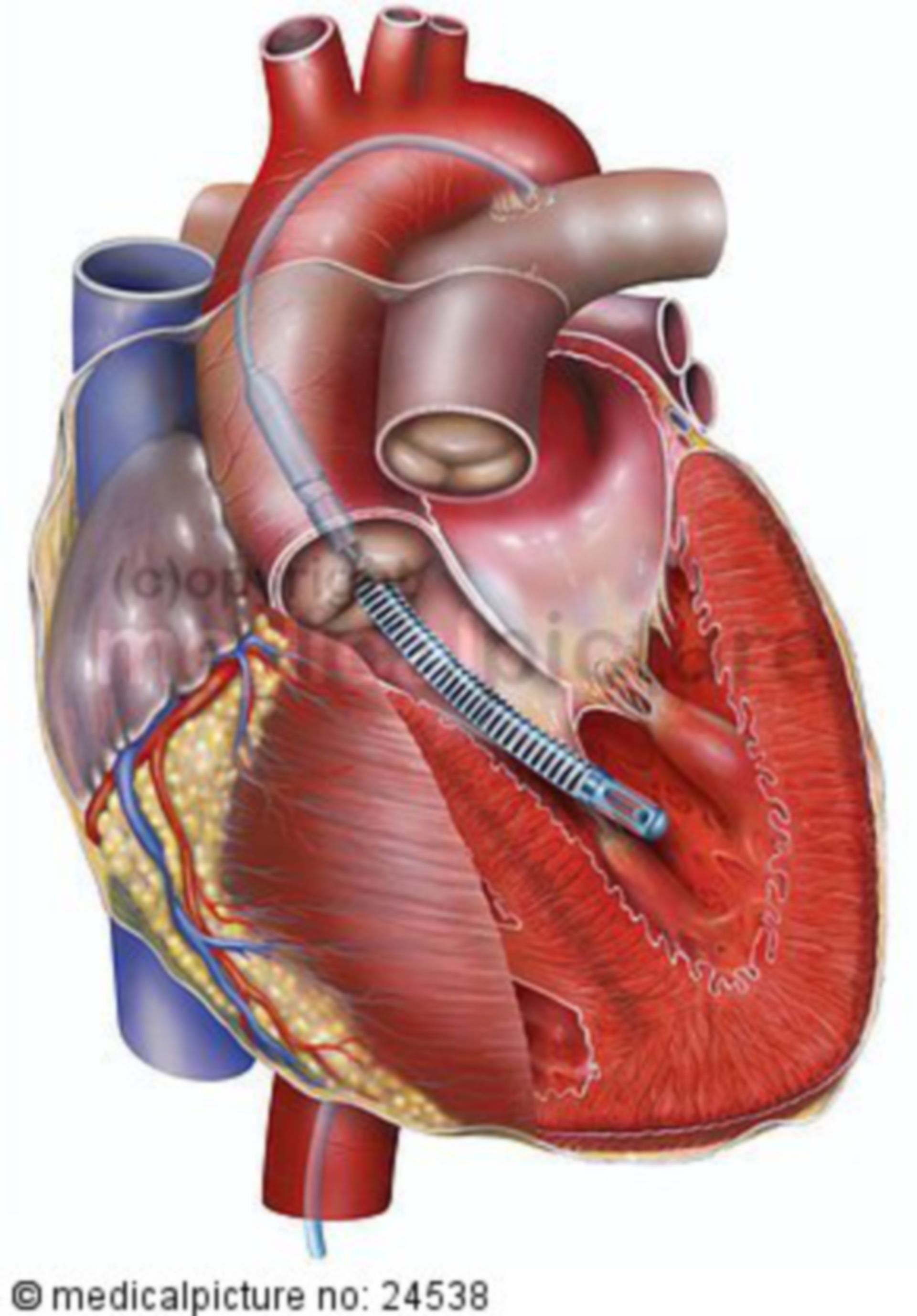 Ventricular heart support , detail